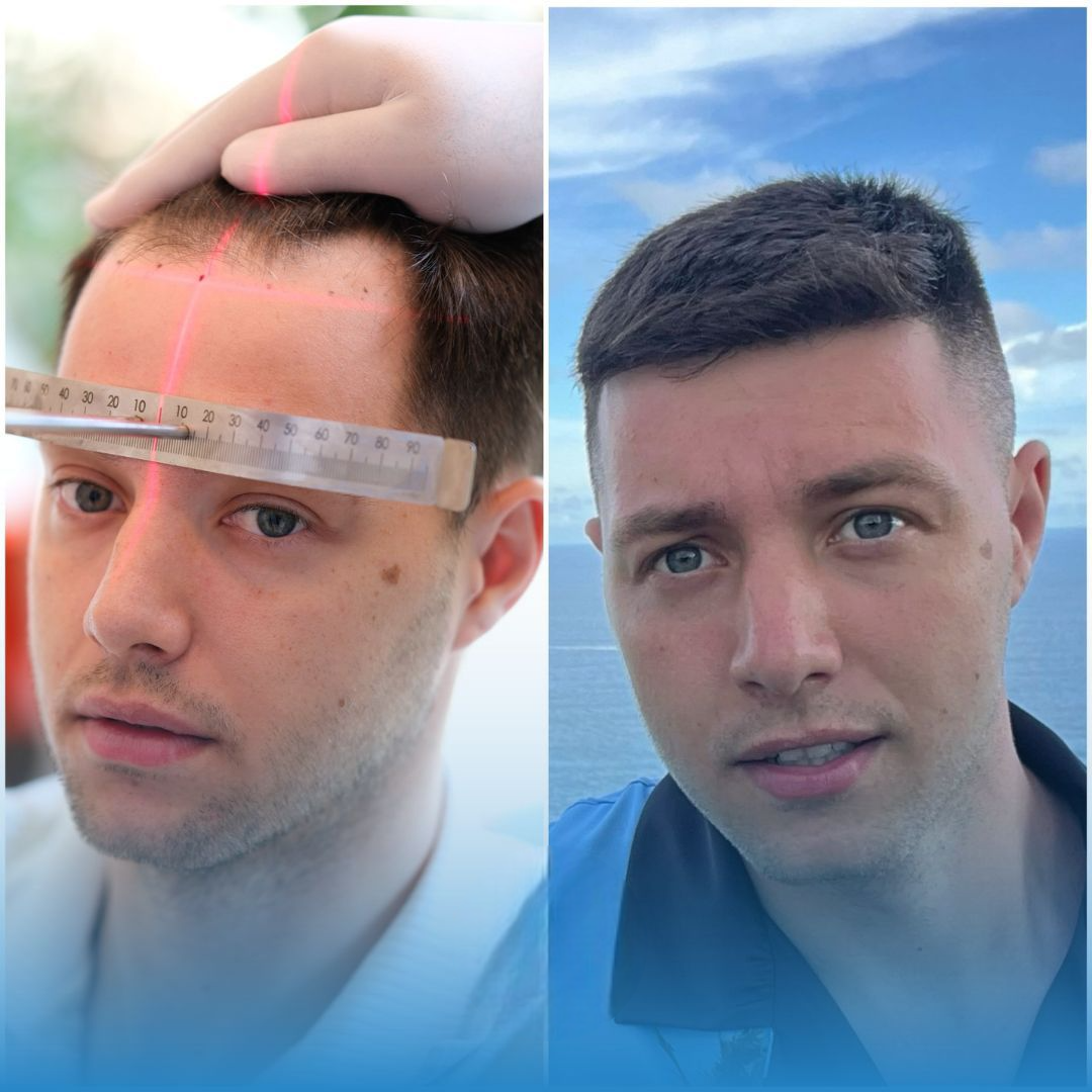 Saç Ekimi, FUE Saç Ekimi, DHI Saç Ekimi, Saç Ekimi Türkiye, Doğal Saç Ekimi, Saç Dökülmesi, Saç Ekimi Sonuçları, İstanbul Saç Ekimi, Hair Transplant, FUE Hair Transplant, Hair Transplant Turkey, DHI Hair Transplant, Natural Hair Transplant Results, H