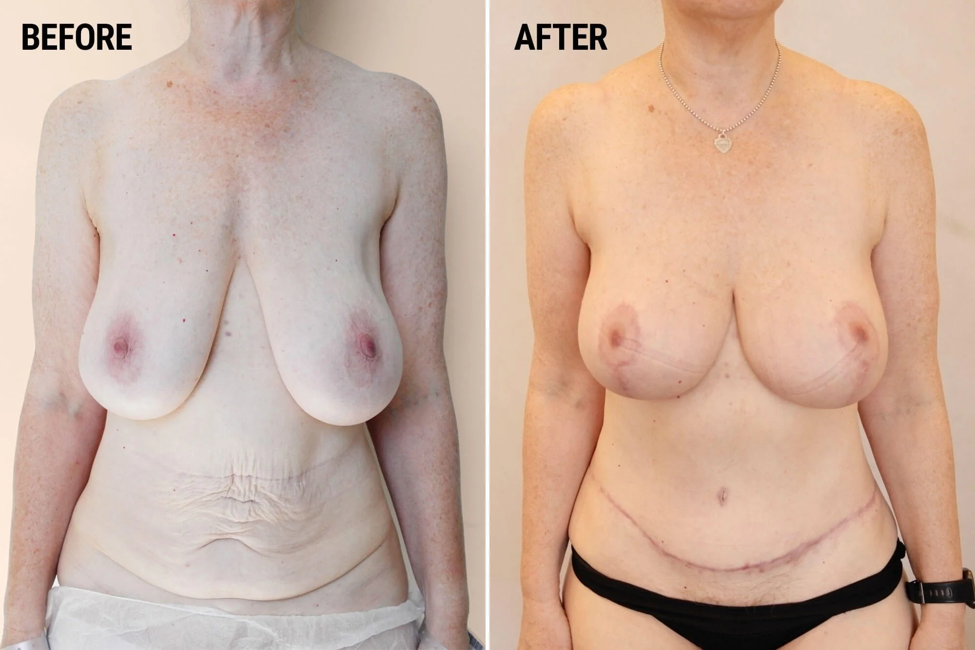 Breast Augmentation Surgery in Dubai