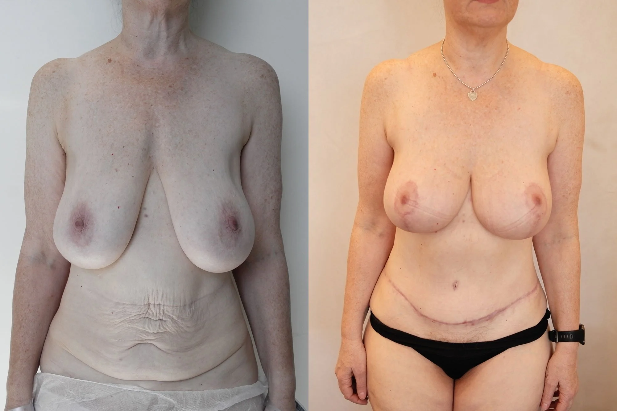 Side-by-side comparison of a woman before and after breast reconstruction surgery. The left shows her with no breasts and loose skin, the right shows her with reconstructed breasts, a surgical scar across the abdomen, and wearing black underwear and 