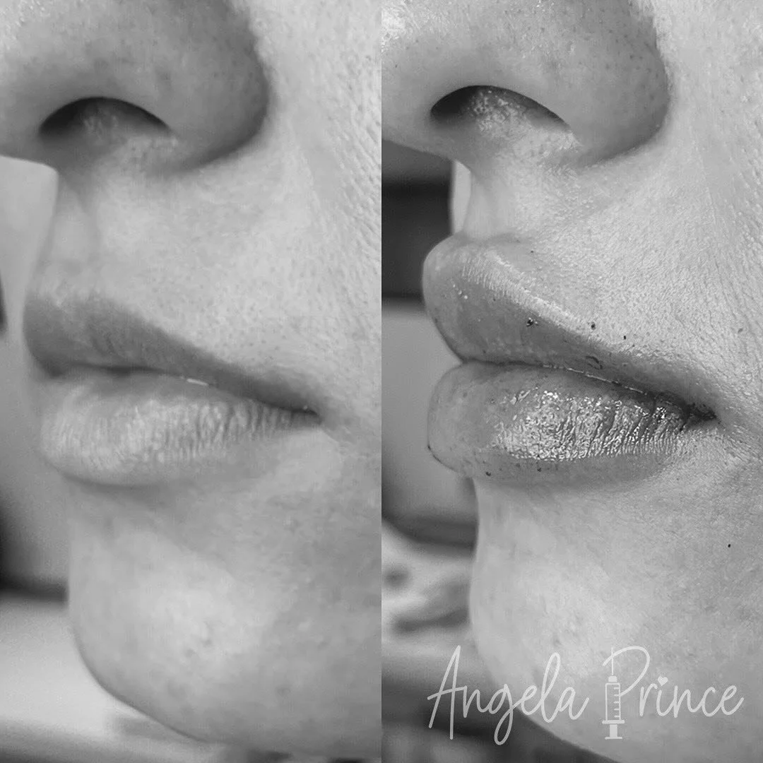 Confidence is the best makeup, but a little lip filler never hurt either 💋💉 

BOOK NOW | LINK IN BIO 👆🏼 

#angelaprincern #cosmeticnurseinjector #michiganbeauty #birminghammi #perfectpout #lipgoals #downtownbirmingham