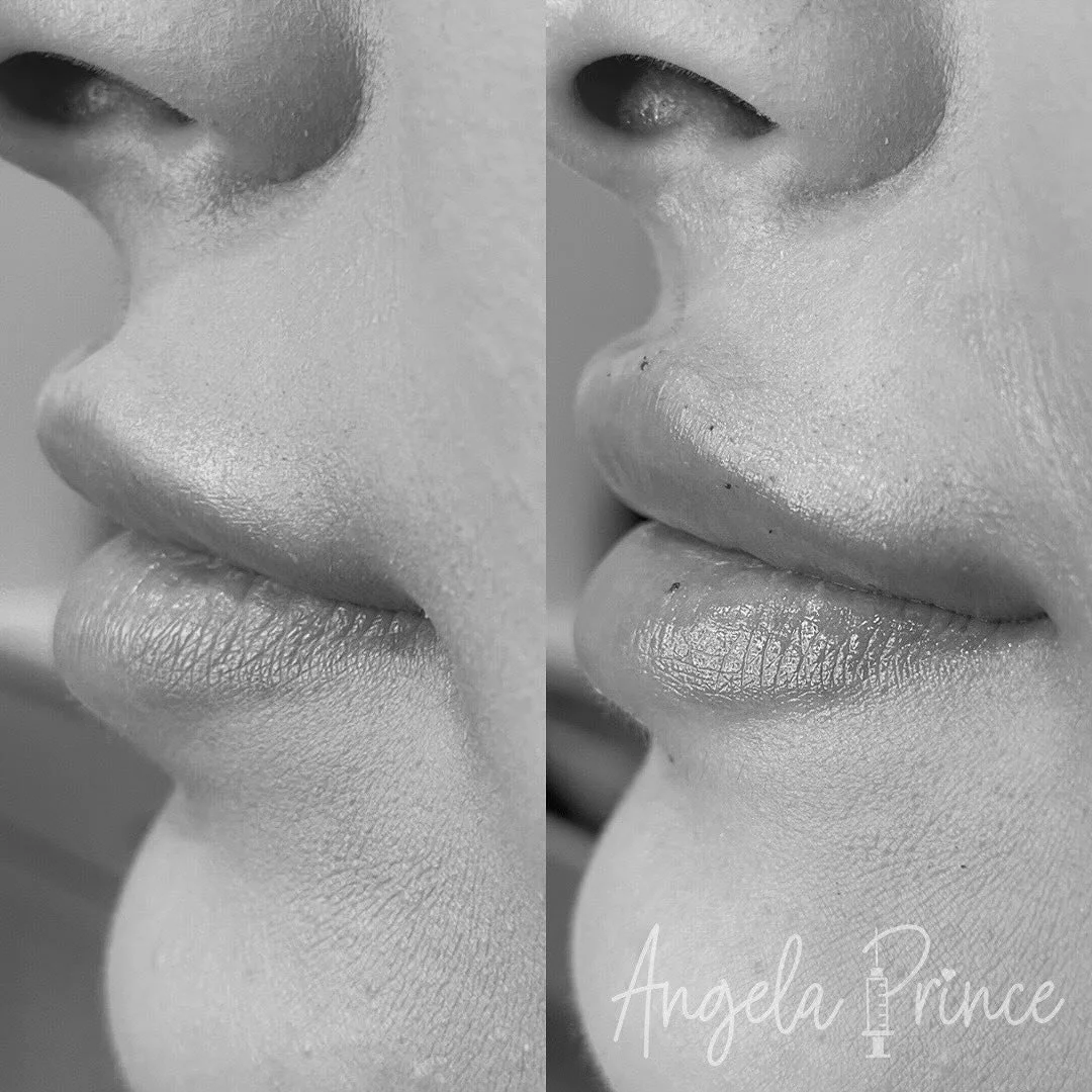 ✨ Transformation Time! ✨

Check out the amazing difference that Restylane Contour can make- fuller, more defined lips that look totally natural. 💋

BOOK NOW | LINK IN BIO 👆🏼

#angelaprincern #restylanecontour #lipgoals #michiganbeauty #liptransfor