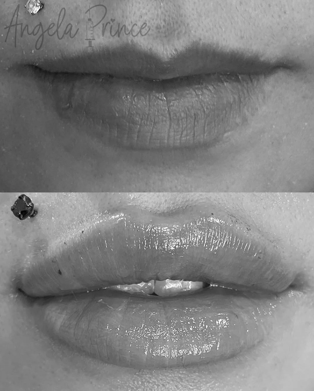 💉✨ Lip filler isn&rsquo;t about changing your look &mdash; it&rsquo;s about enhancing what&rsquo;s already there.

Notice how the after photo shows:
✔️ Balanced proportions
✔️ Defined borders
✔️ Soft, natural volume

🍂 Fall Promo: Book now and take