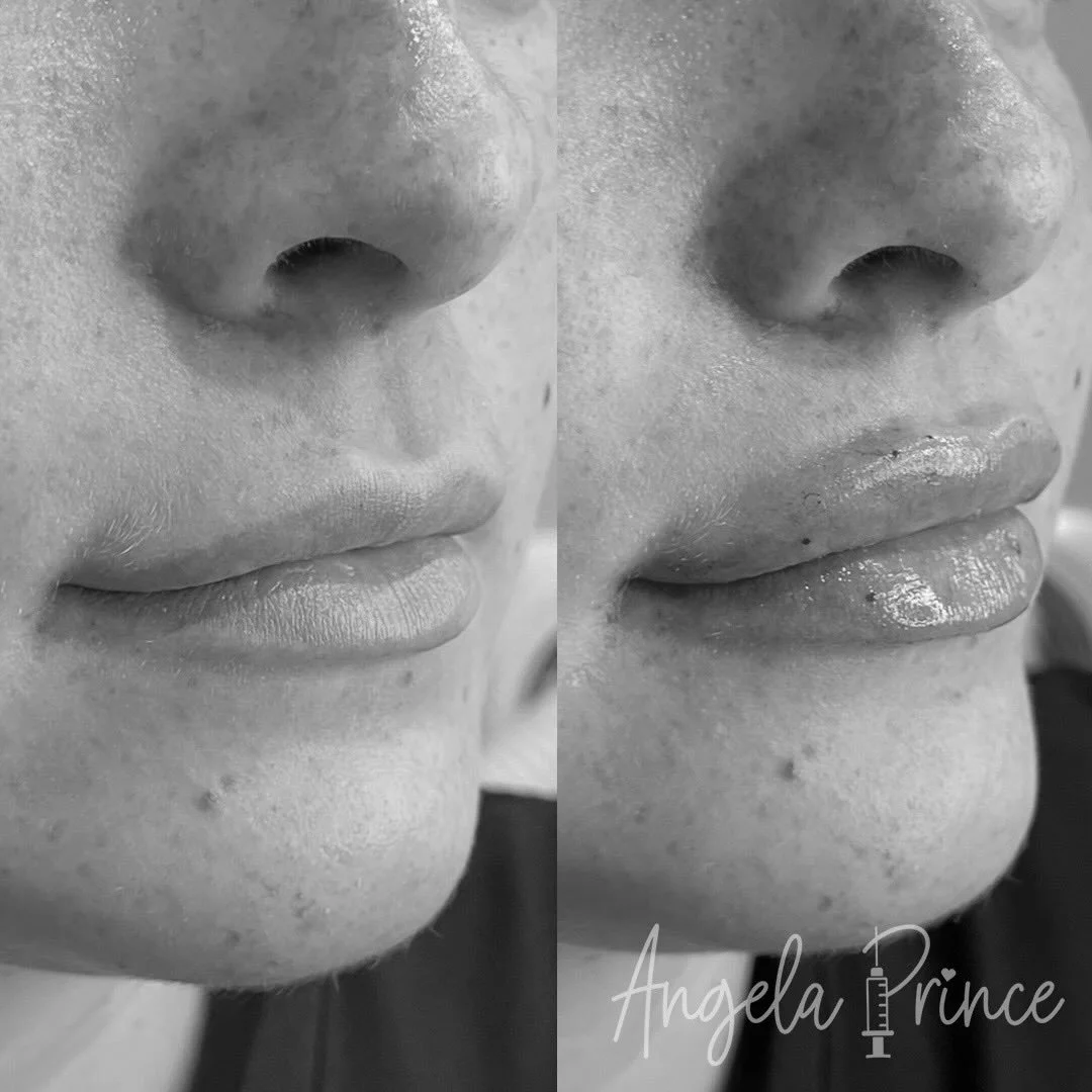 Fresh lips, soft shape, natural volume ✨

This result is all about balance: enhancing the lip without overpowering the face. A little structure, a little hydration, and a whole lot of pretty.

📍Birmingham, MI
💉 Angela Prince RN, BSN
🔗 Book through