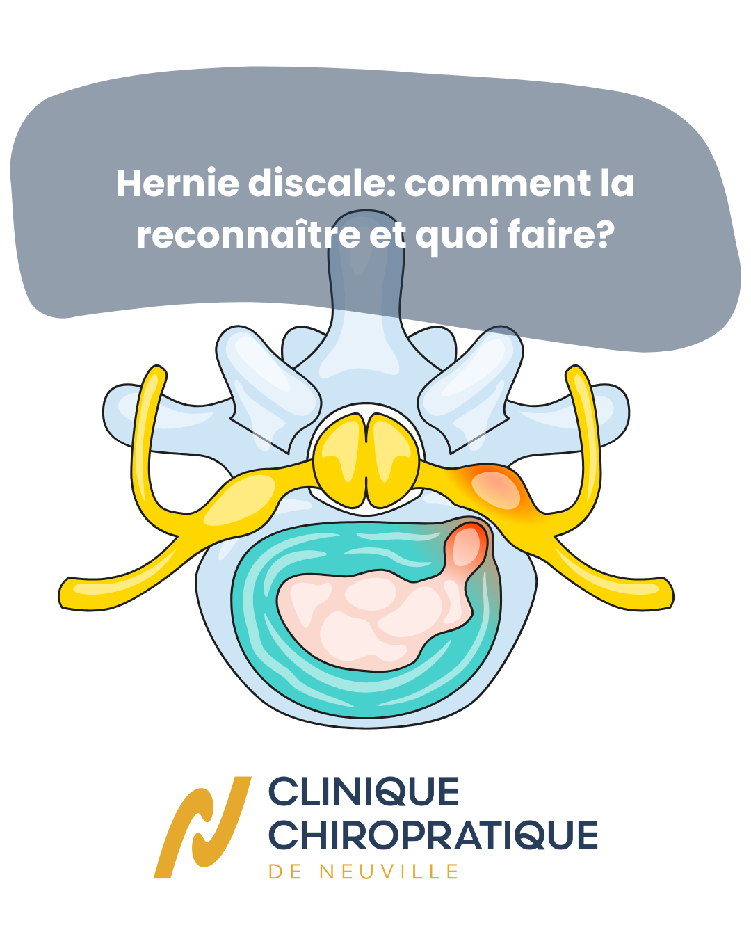 Hernie discale: comment la reconnaître et quoi faire?