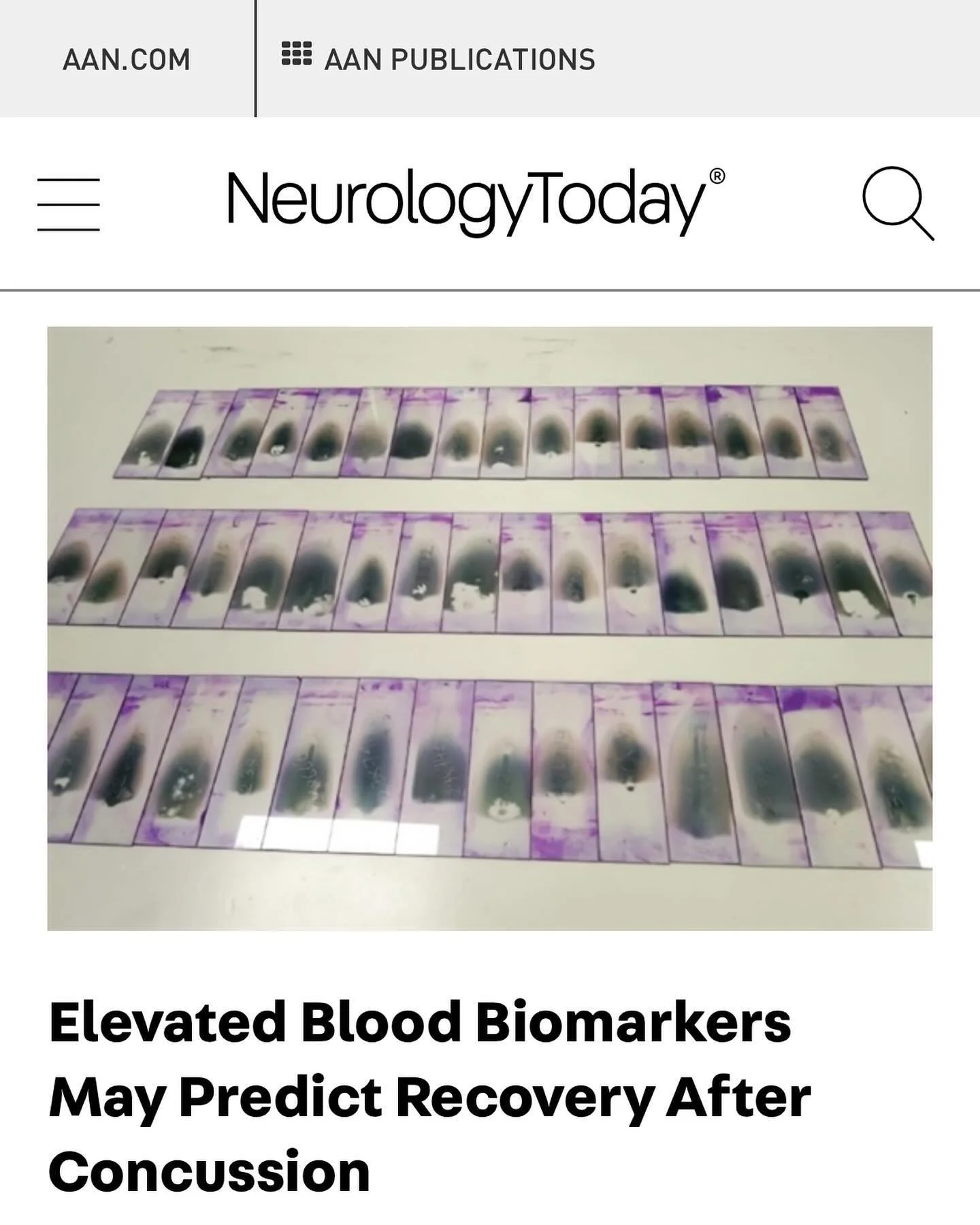 Glad to have been featured in this article titled &ldquo;Elevated Blood Biomarkers May Predict Recovery After Concussion&rdquo; by Olga Rukovets which was published recently in Neurology Today. I enjoyed my conversation with Olga on concussion biomar