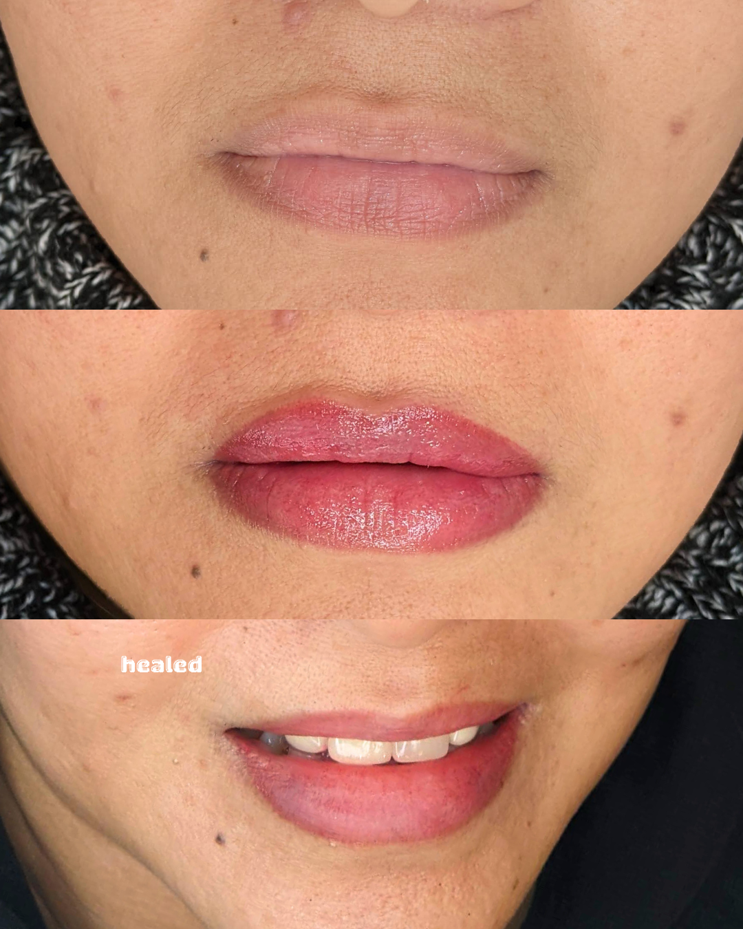 Lips Before After 1006 (1).png