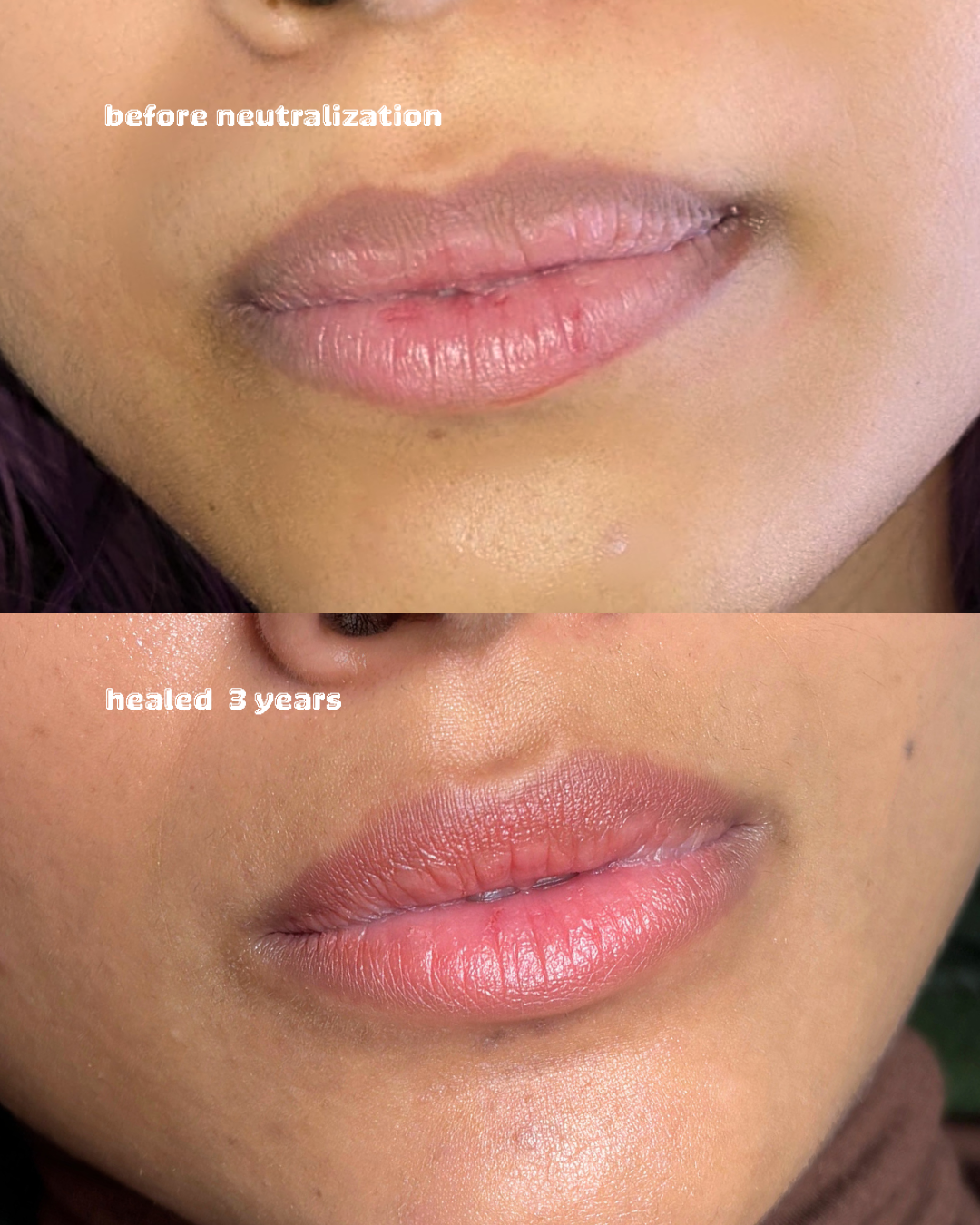 Lips Before After 1006.png
