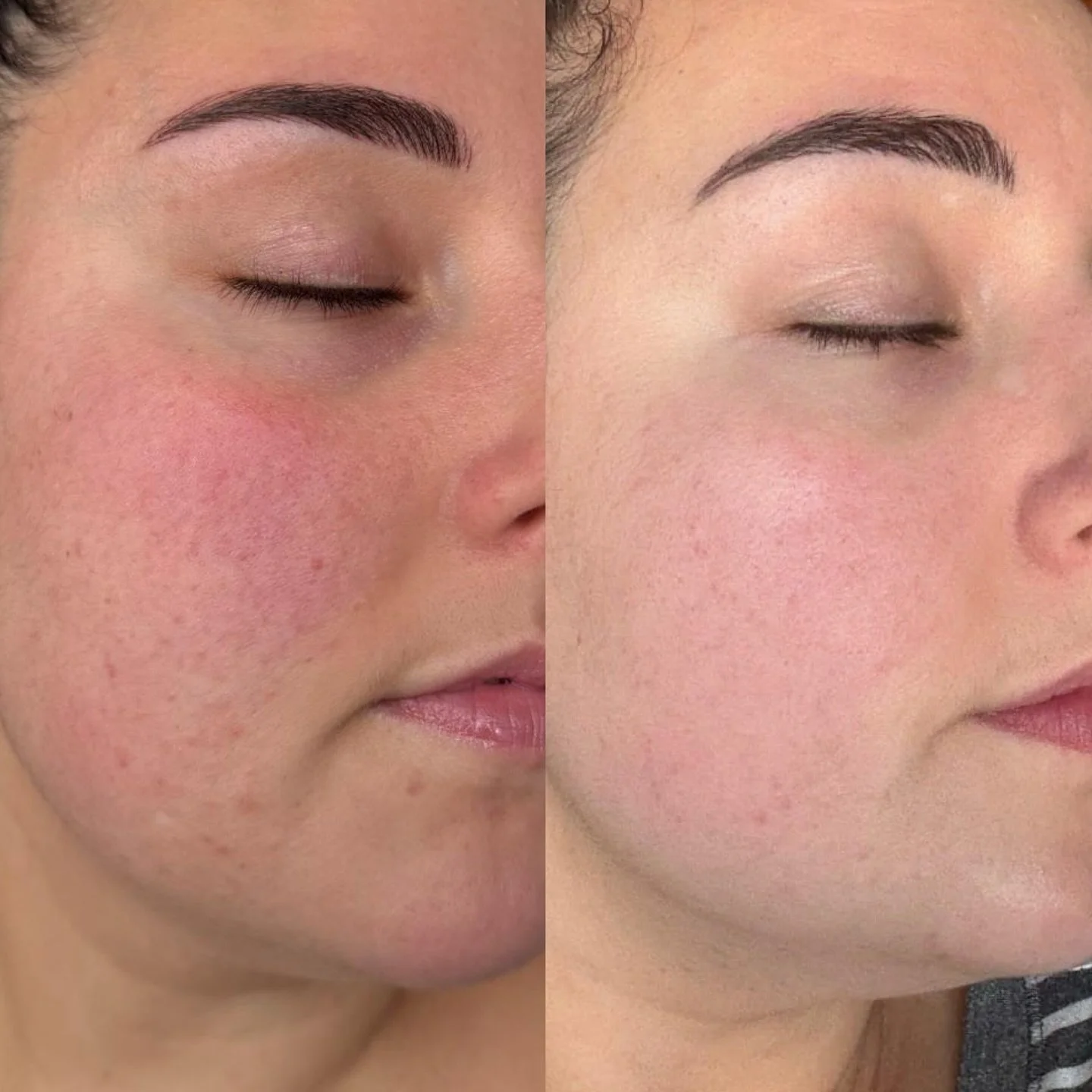 R&eacute;sultat apr&egrave;s 1 consultation Protocole de Peau ✨

L&rsquo;incroyable avant/apr&egrave;s de la sublime &Eacute;meline, en seulement 2 mois. 

✅ Une peau nettement moins inflamm&eacute;e 
✅ Moins de rougeurs et d&rsquo;imperfections 
✅ U