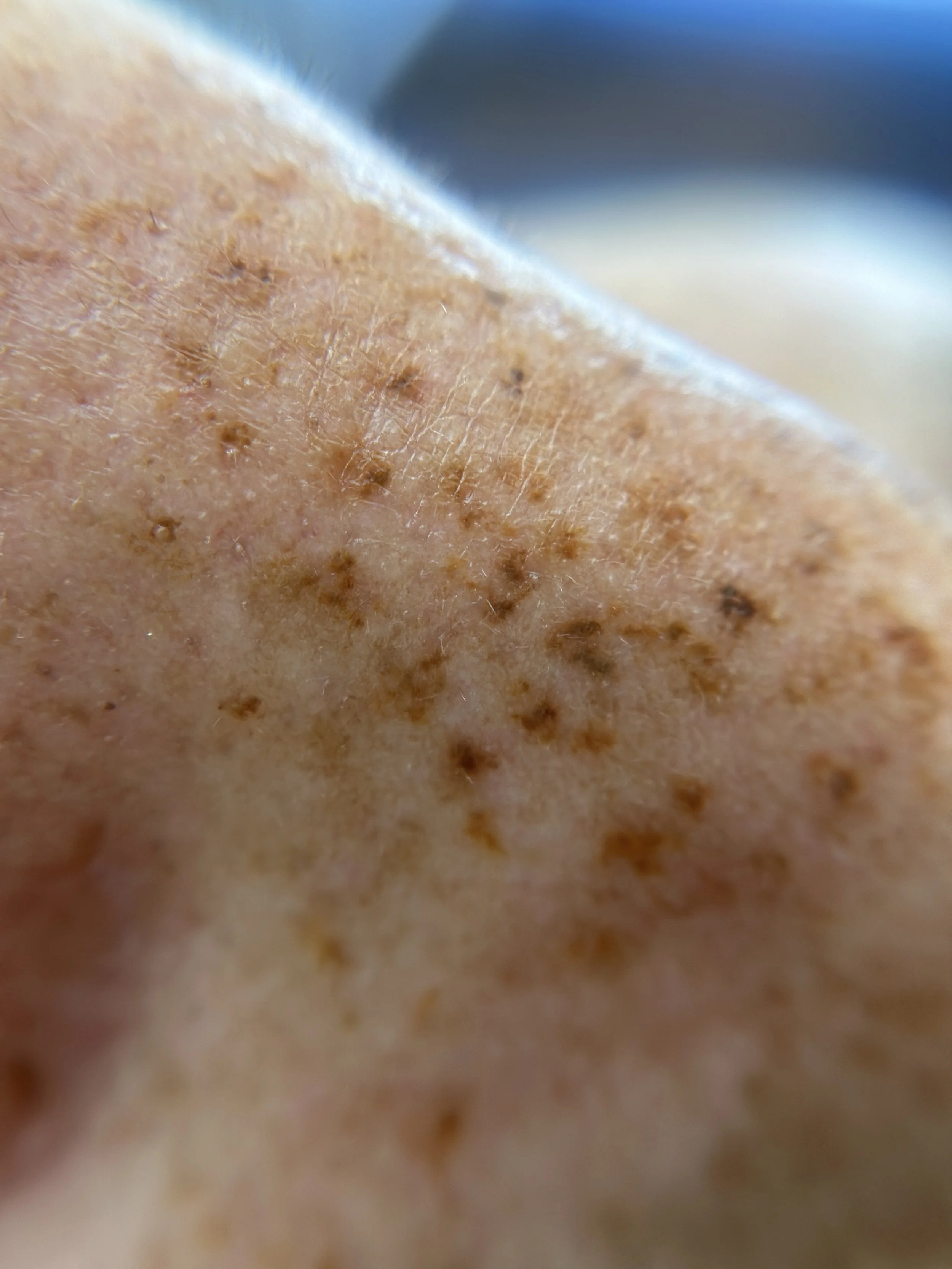 macro lens healed faux freckles