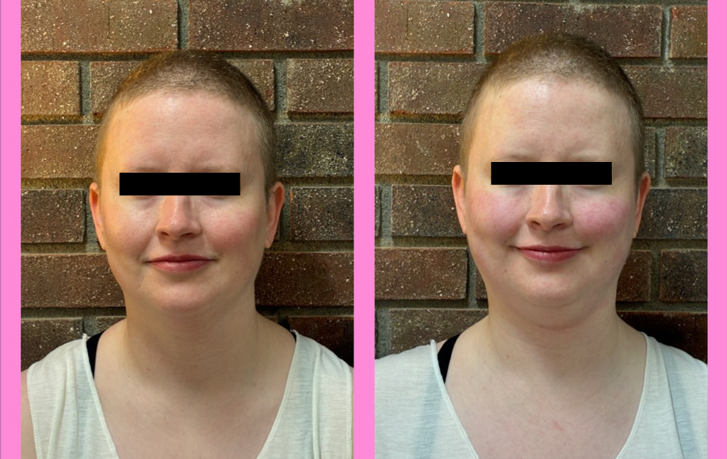 Before and after photos from Buccal Face & Jaw Release treatment for jaw and facial tension