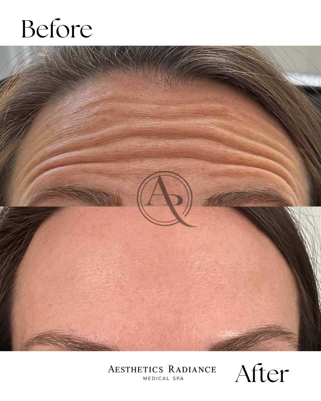 Comparison of a woman's forehead before and after aesthetic treatment; the "before" image shows deep forehead wrinkles, while the "after" image shows smooth, wrinkle-free skin. Text includes 'Before', 'After', and branding for Aesthetics Radiance Medical Spa.
