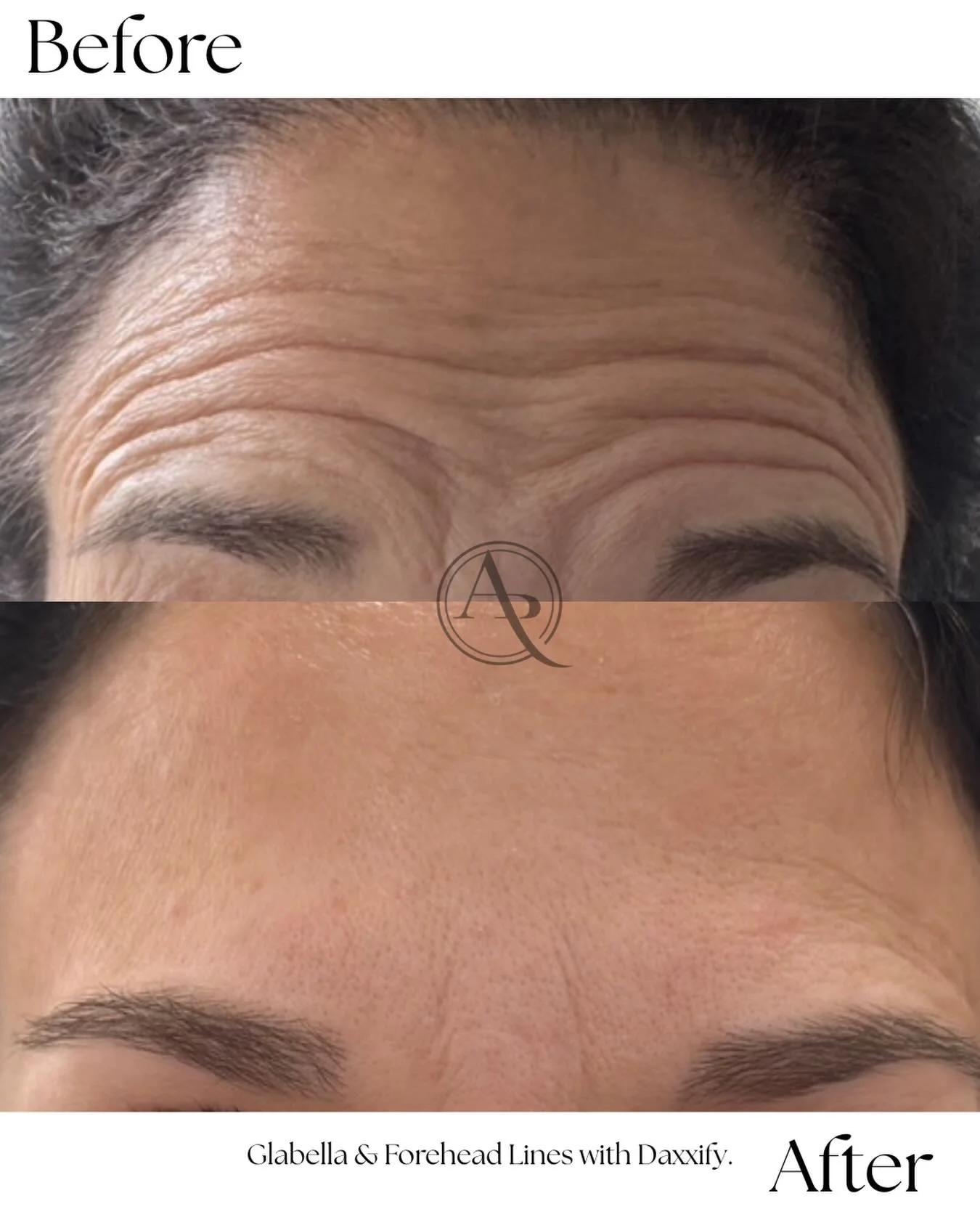 This before &amp; after showcases the power of Daxxify treating forehead + glabellar lines&mdash;softening expression lines while maintaining beautiful movement.

Results that don&rsquo;t look &ldquo;done&rdquo;&hellip; just well-rested and radiant.
