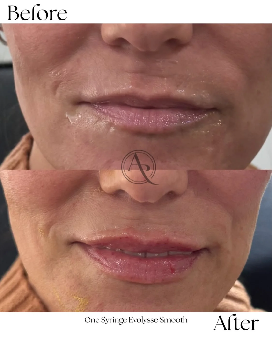 Balanced volume, enhanced shape, and seamless movement using Evolysse&mdash;engineered with cold processing technology and made in the USA for refined, natural results.

Results that speak for themselves.
📅 Book your lip consultation.

#pittsburghme
