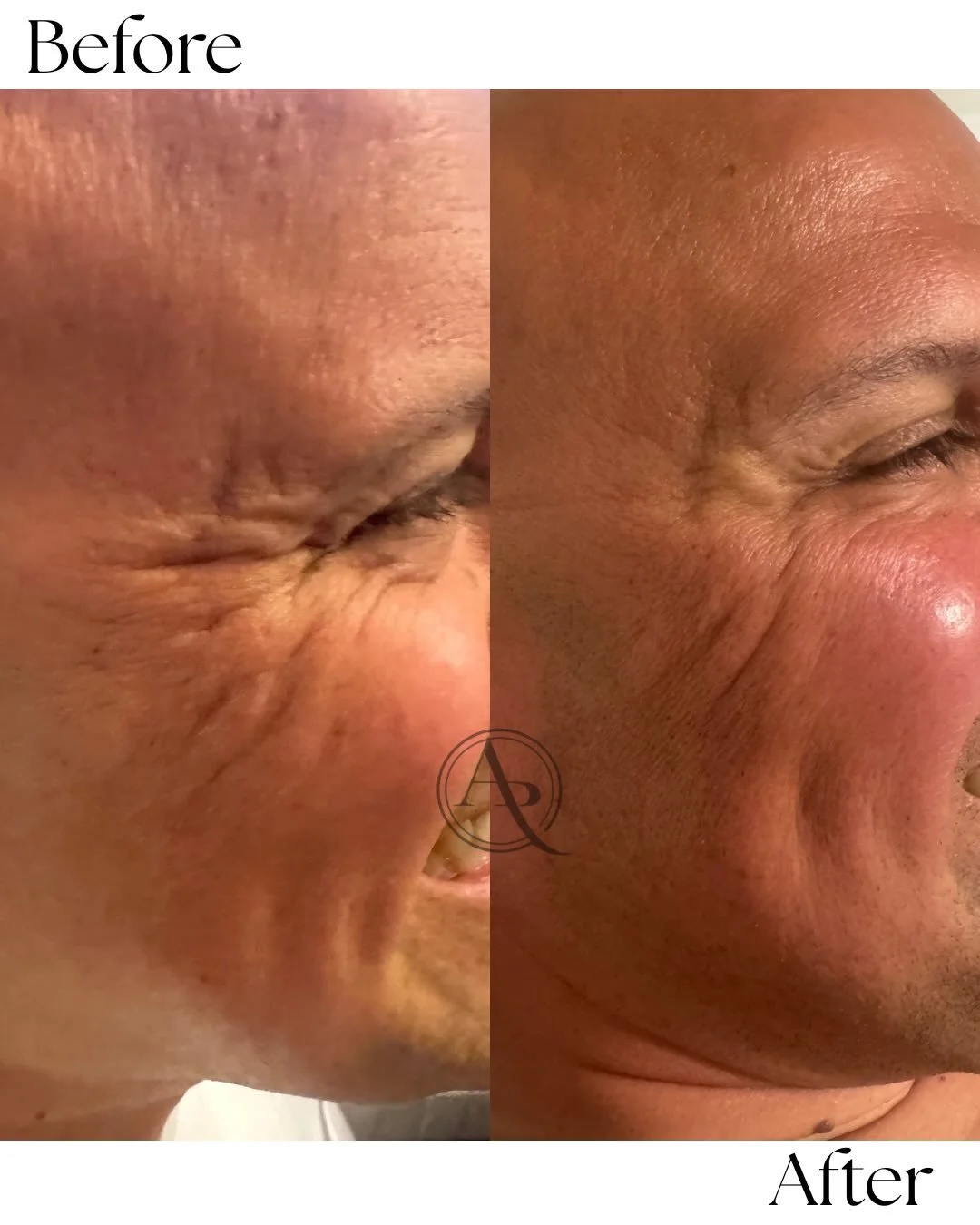 Two different faces, same goal&mdash;natural, refreshed eyes.
Results are always customized because no two clients are the same 🤍

DM or click the link in our bio to book your consultation now!

#pittsburghmedspa #pittsburghinjector