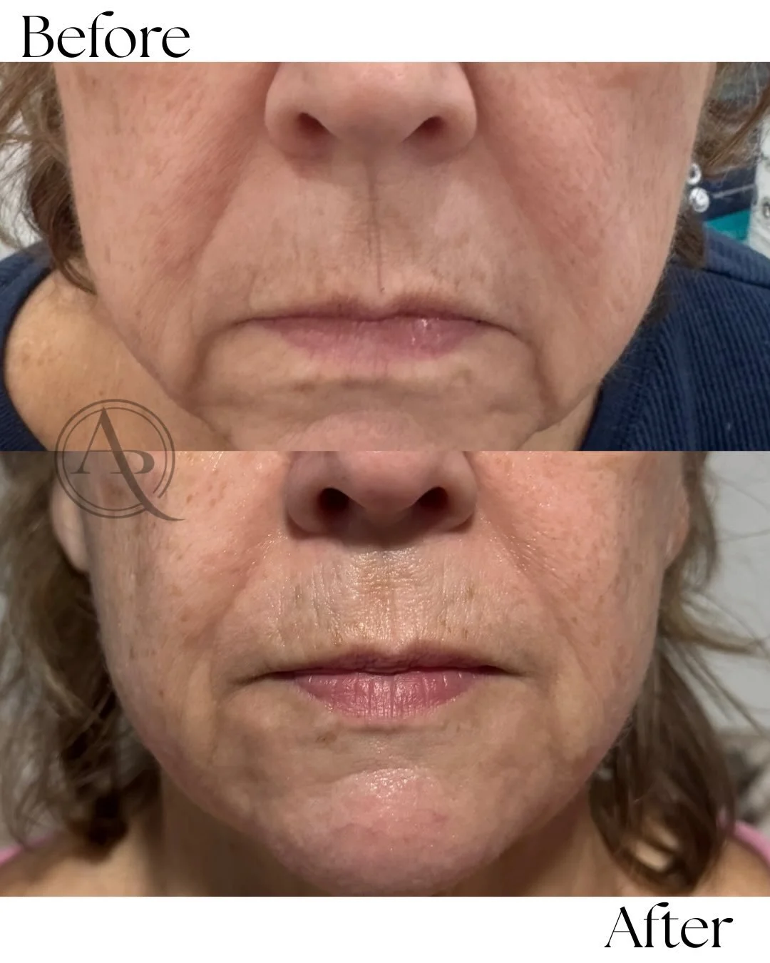Subtle. Strategic. Transformational. ✨

Facial balancing isn&rsquo;t about changing who you are&mdash;it&rsquo;s about refining harmony, enhancing proportions, and letting your natural beauty take center stage.

No filters. No overdone results. Just 