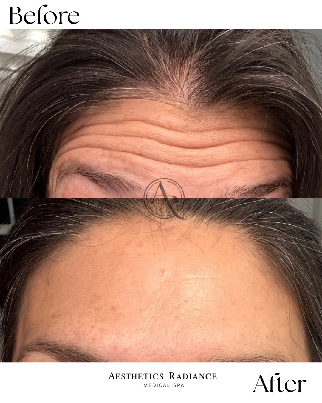Smooth, refreshed, and naturally radiant ✨

These forehead line before &amp; afters are proof that subtle enhancements can make such a beautiful difference. At Aesthetics Radiance Medical Spa, our goal is always natural-looking results that help you 