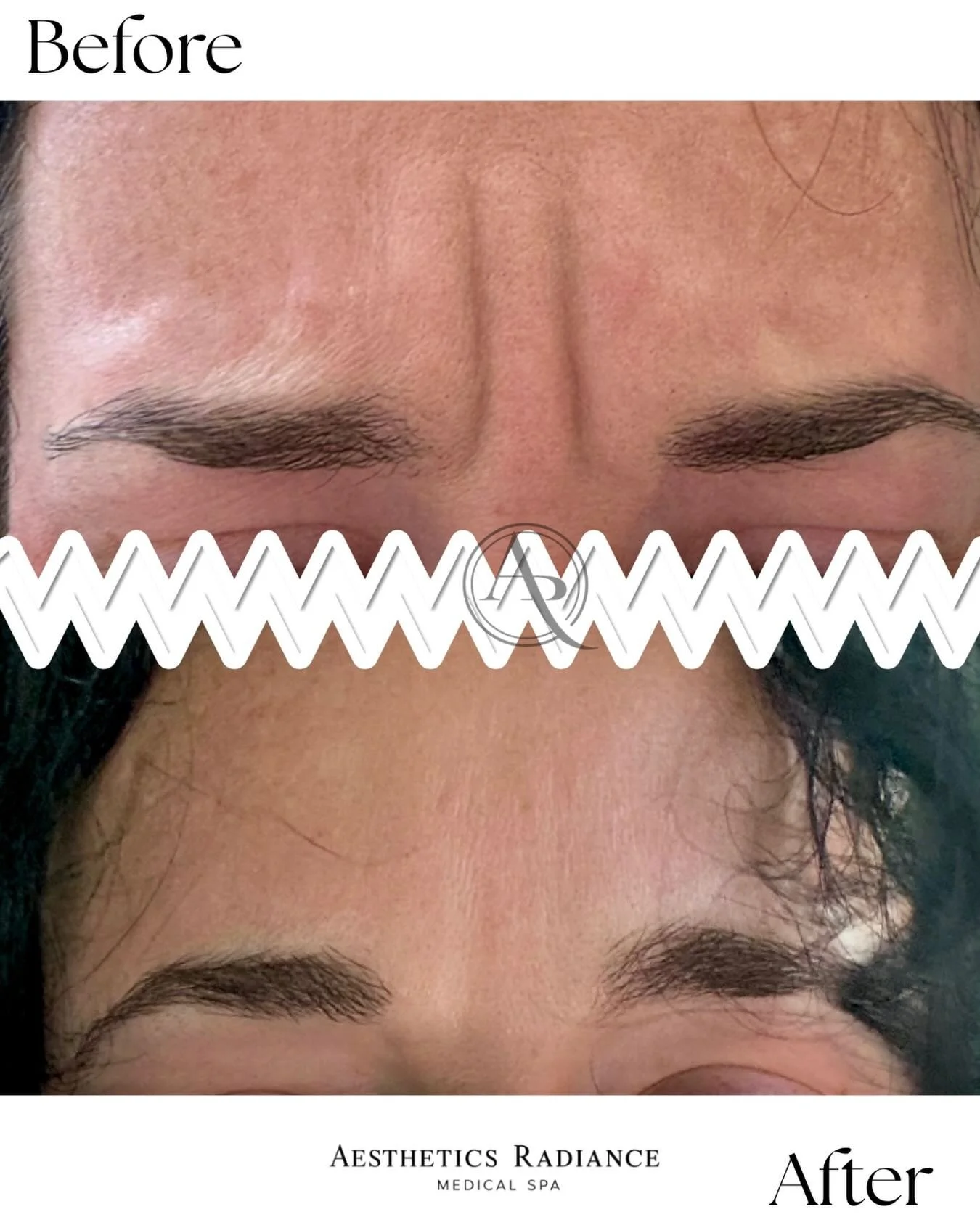 ✨ Subtle enhancements, beautiful results ✨

This before &amp; after shows the power of personalized aesthetic treatments.

Our goal is always to enhance your natural features while keeping your results looking refreshed and balanced.

Every treatment