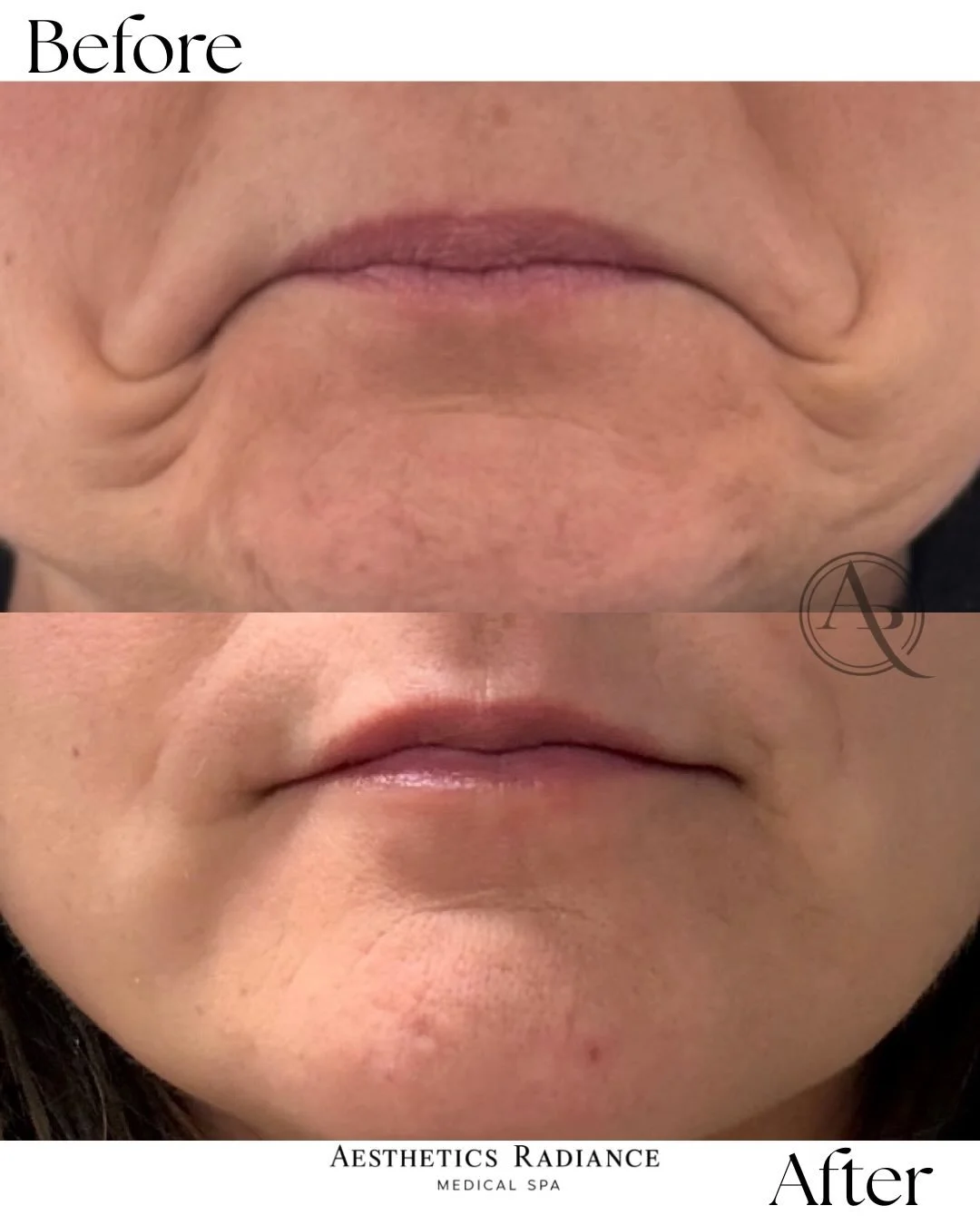 These before &amp; afters showcase the power of Restylane&reg; Contour to restore volume, soften deeper folds, and create a smoother, more refreshed appearance&mdash;all while maintaining natural facial movement.

💉 Enhanced cheek support
💉 Softene