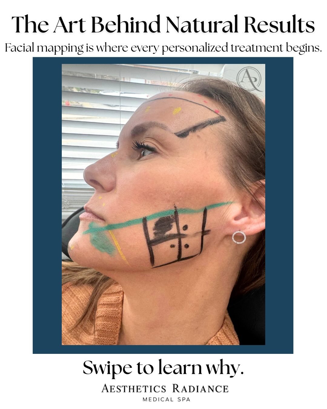 Luxury aesthetics begin with intention.
Facial mapping is one of the most important steps in creating refined, natural-looking results. Before any treatment, we take the time to assess your unique facial anatomy, movement, proportions, and goals to d