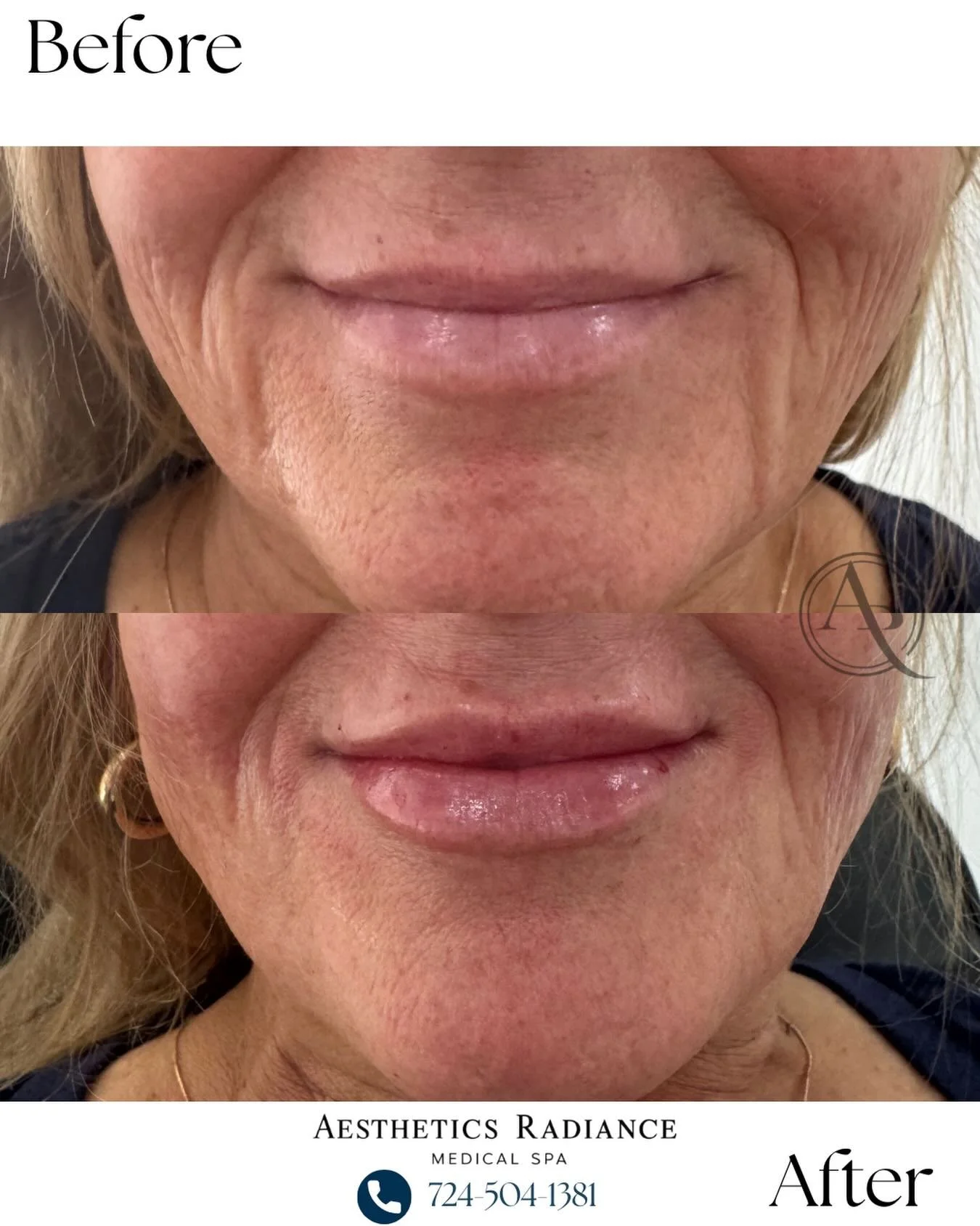 Not every lip filler treatment is about adding volume.

For this patient, Restylane Kysse was used to restore structure, enhance lip borders, and rejuvenate the lips for a softer, more refreshed appearance.

Notice the improved definition, subtle ful