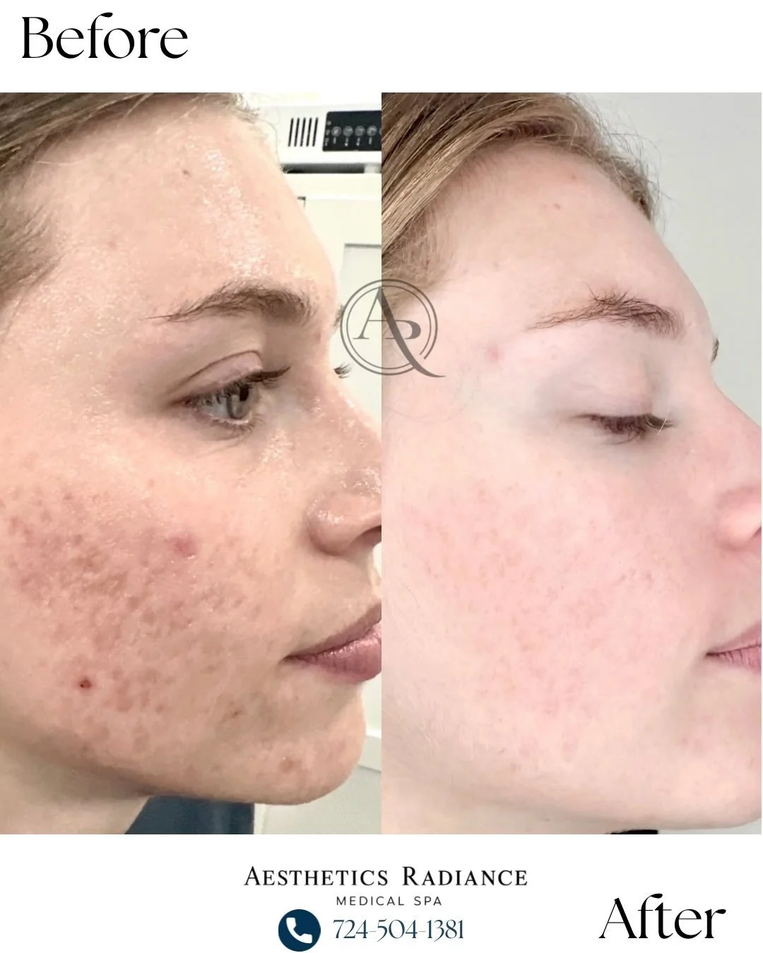 Acne and acne scarring don&rsquo;t have to be permanent.

These results were achieved with a series of 3 microneedling treatments combined with a customized medical-grade skincare regimen. By stimulating collagen production and supporting healthy ski