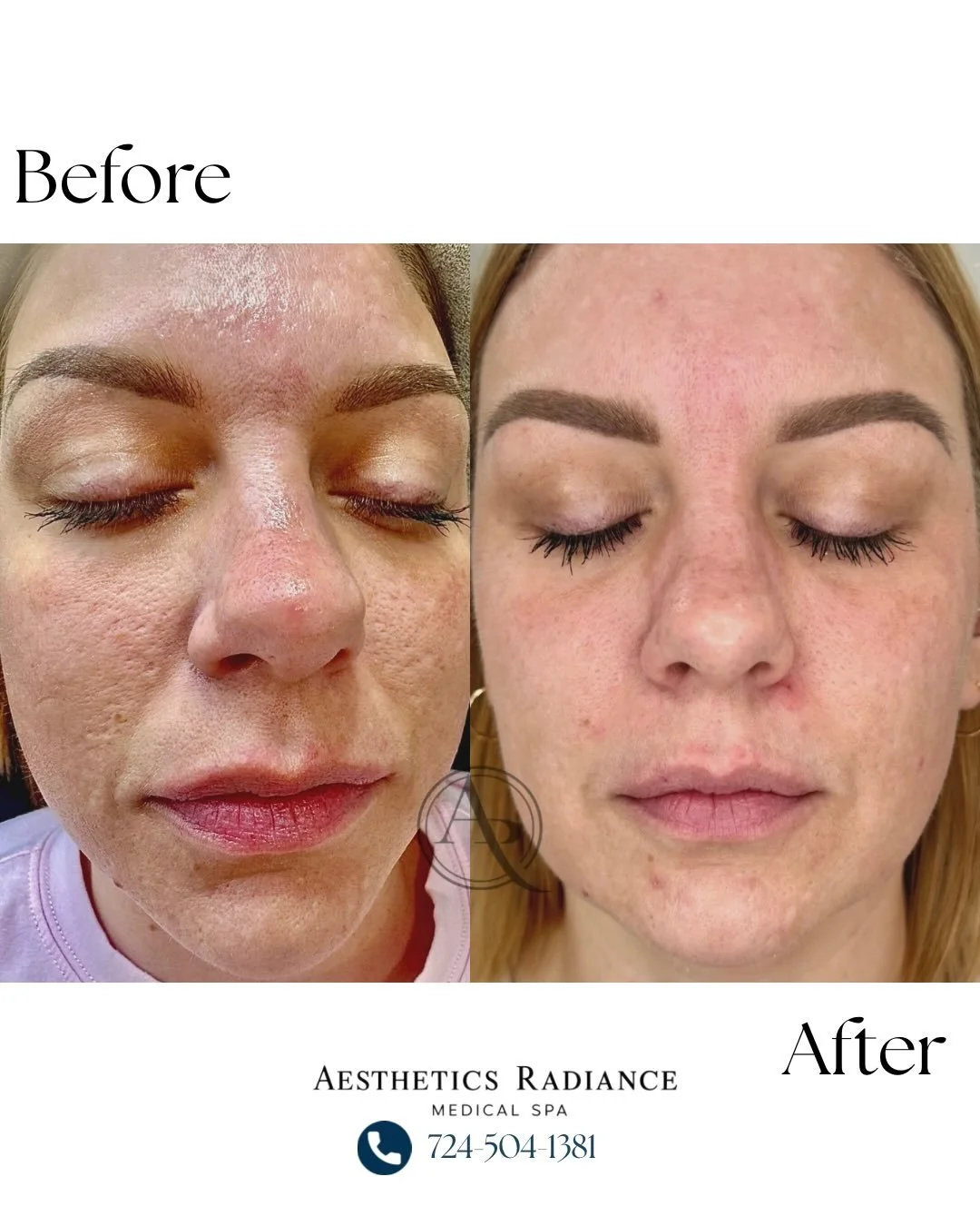 ✨ Results powered by Microneedling + Epicutis.

This transformation was achieved using microneedling with the Epicutis Glide, followed by the Epicutis Lipid Recovery Mask post-treatment and a customized Epicutis home skincare regimen to support heali