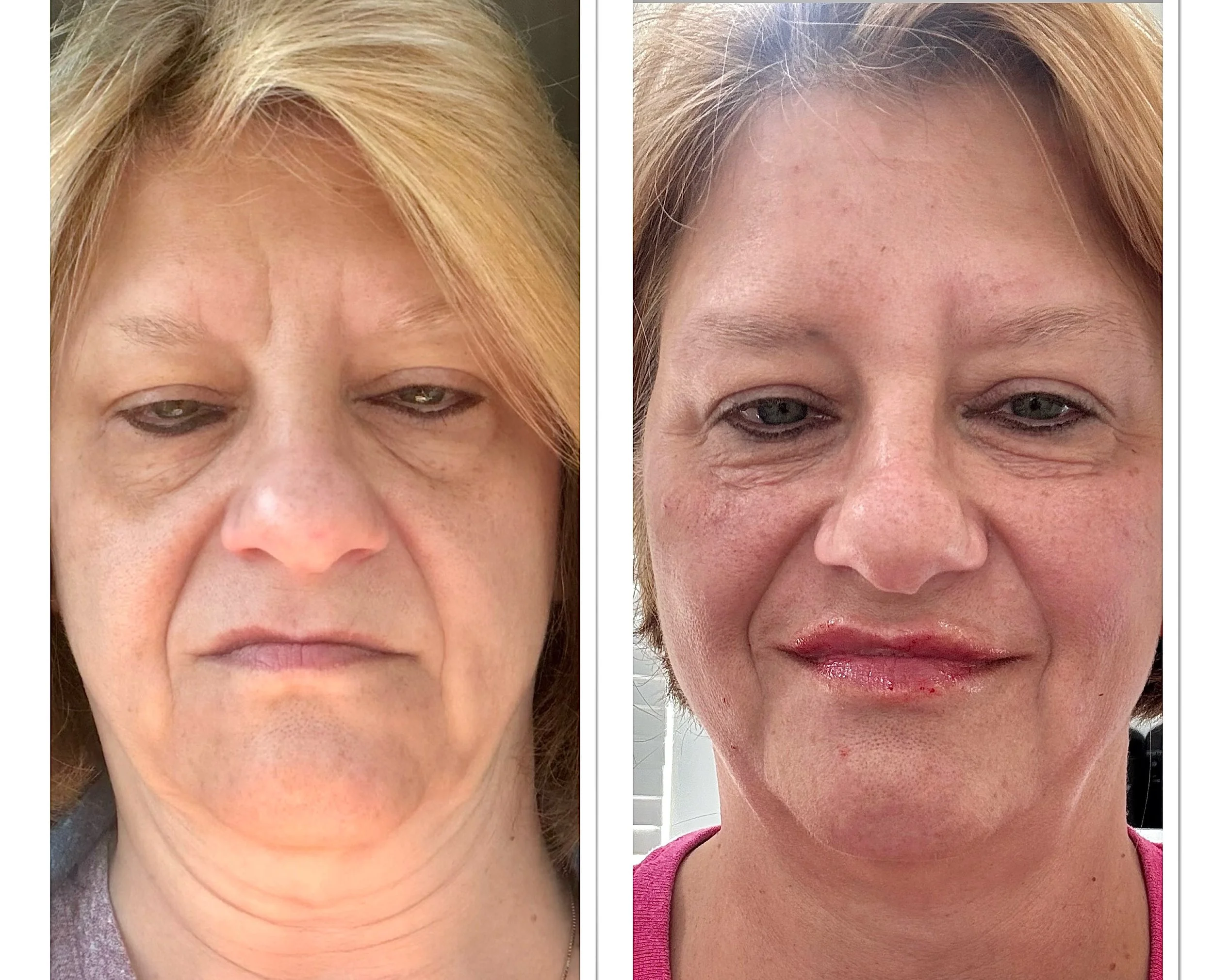 ✨ FACIAL BALANCING | SUBTLE. BEAUTIFUL. RADIANT.YOU. ✨

Facial balancing isn&rsquo;t about changing your face&mdash;it&rsquo;s about enhancing the features you already have and creating harmony between them. 🤍

In this before &amp; after, subtle inj