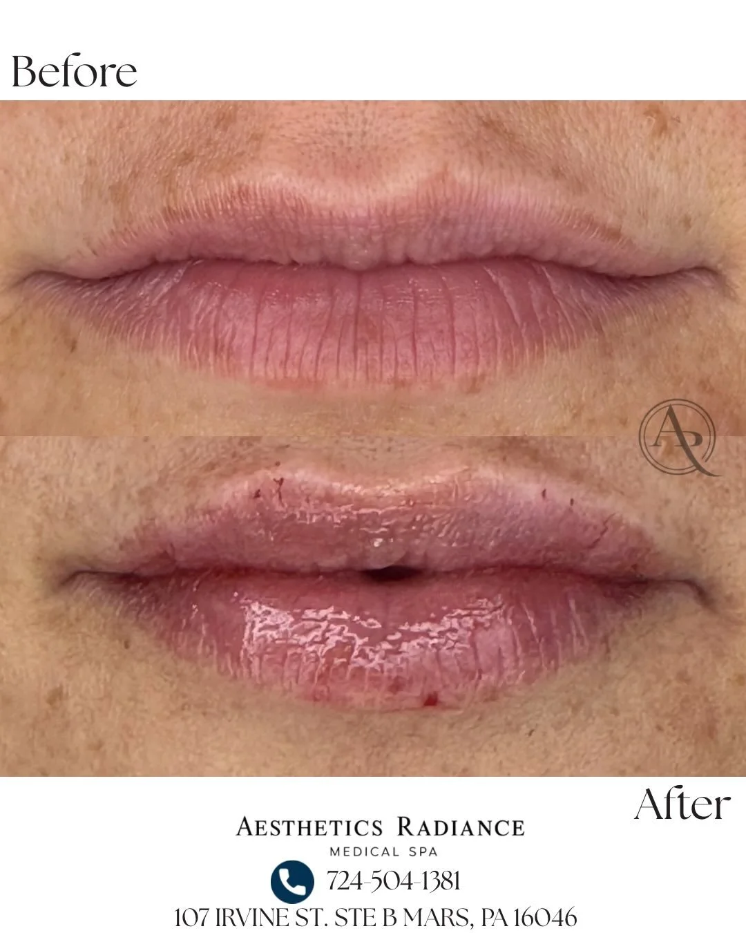Subtle enhancements. Beautifully natural results. ✨

Every lip is unique, and our goal is to enhance your natural beauty, not change it. From soft definition to a little extra volume, lip filler can create balanced, beautiful results that complement 