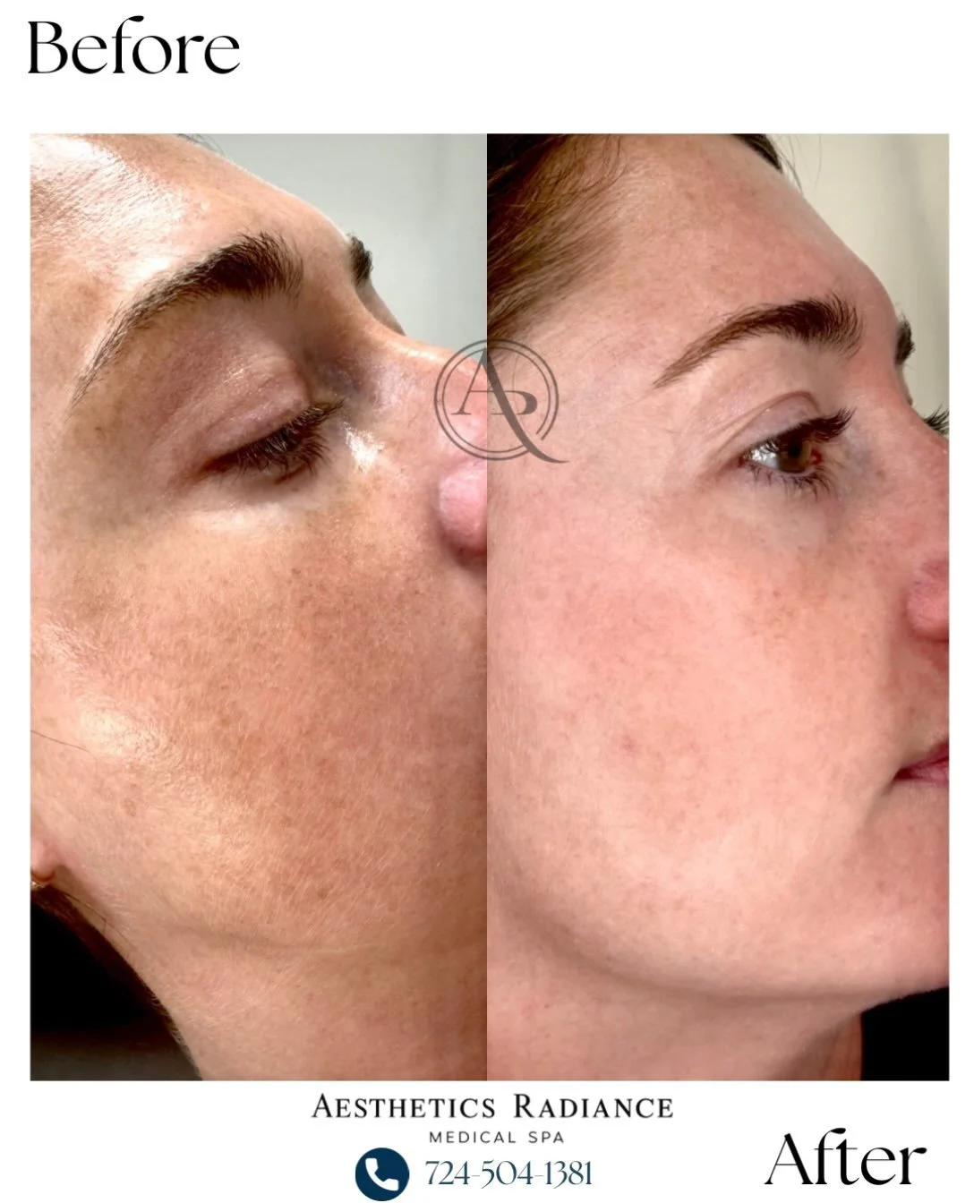 Real results start with the right treatment plan. ✨

This before-and-after shows the progress after just ONE chemical peel, with the client now continuing a customized hyperpigmentation protocol to further target uneven skin tone and discoloration.

