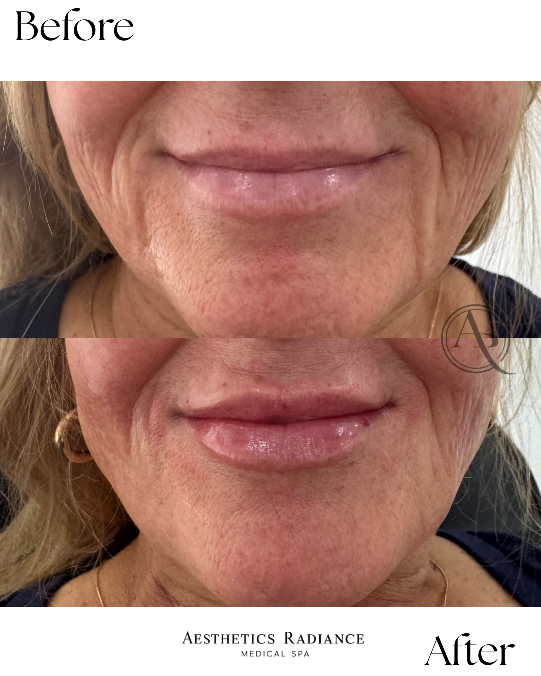 Lip Filler/Flip