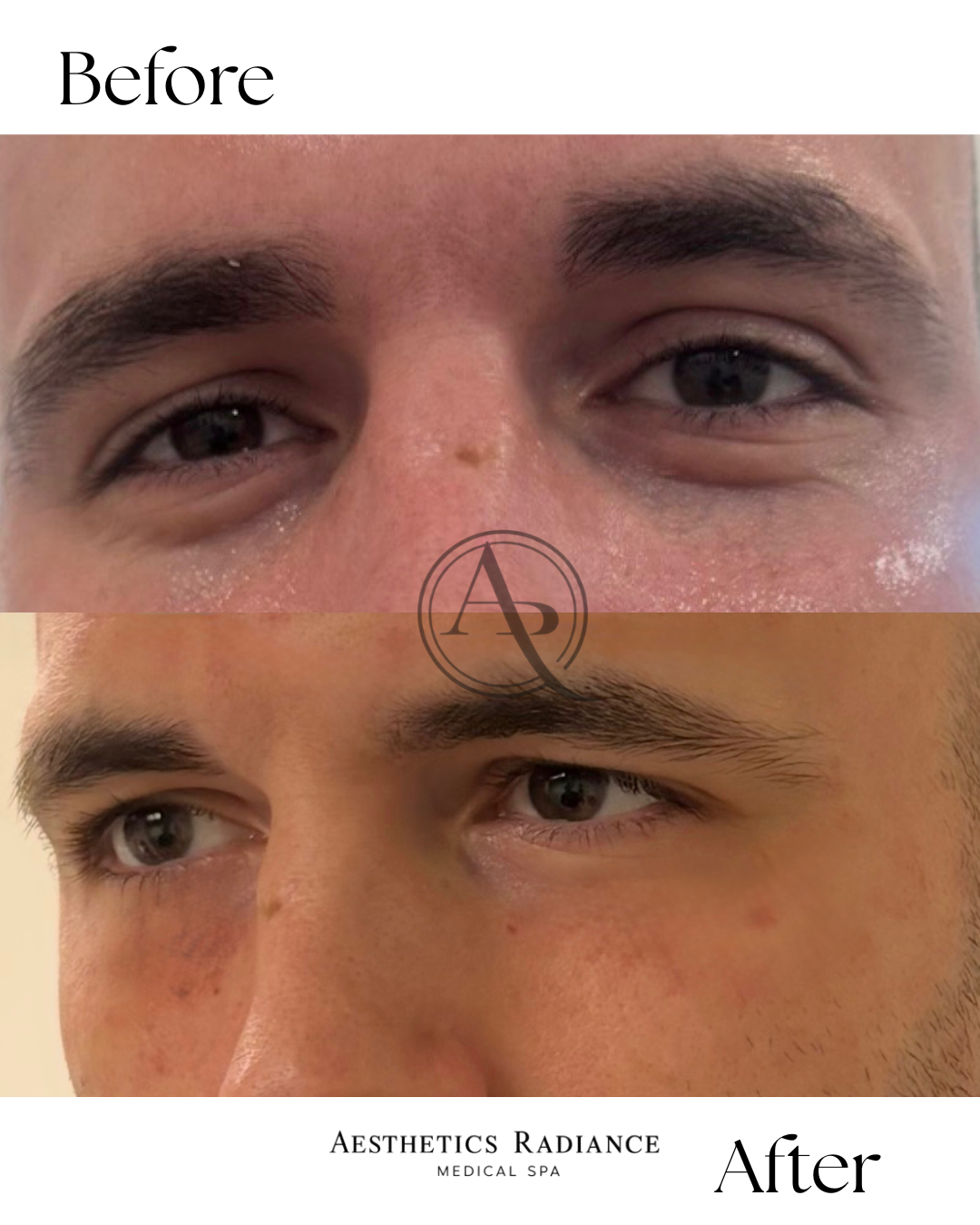Close-up of a person's face before and after aesthetic treatment showing improved skin appearance around the eyes.