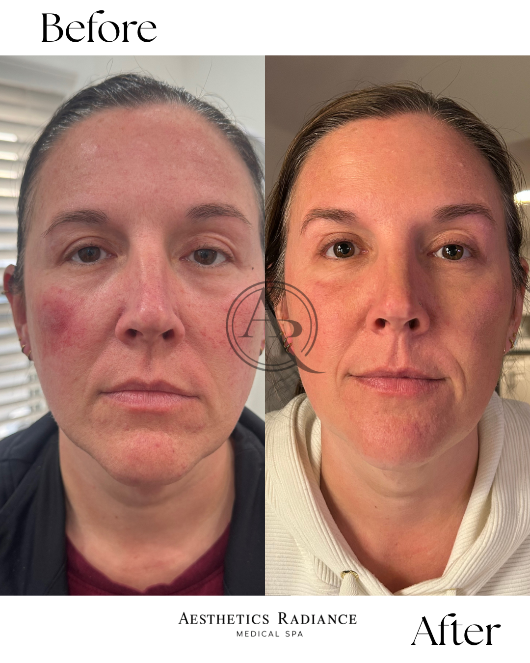Side-by-side comparison of a woman's face before and after skincare treatment, showing reduced redness and smoother skin.