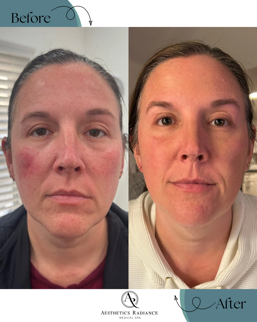 2 weeks post facial balancing