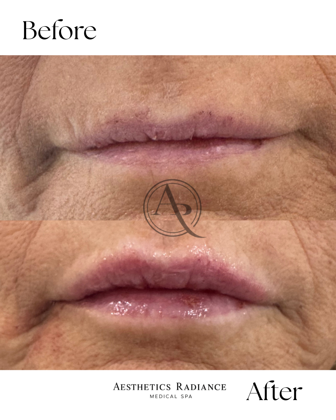 Close-up image showing before and after results of lip cosmetic treatment, with smoother and shinier lips in the after photo, related to Aesthetics Radiance Medical Spa.