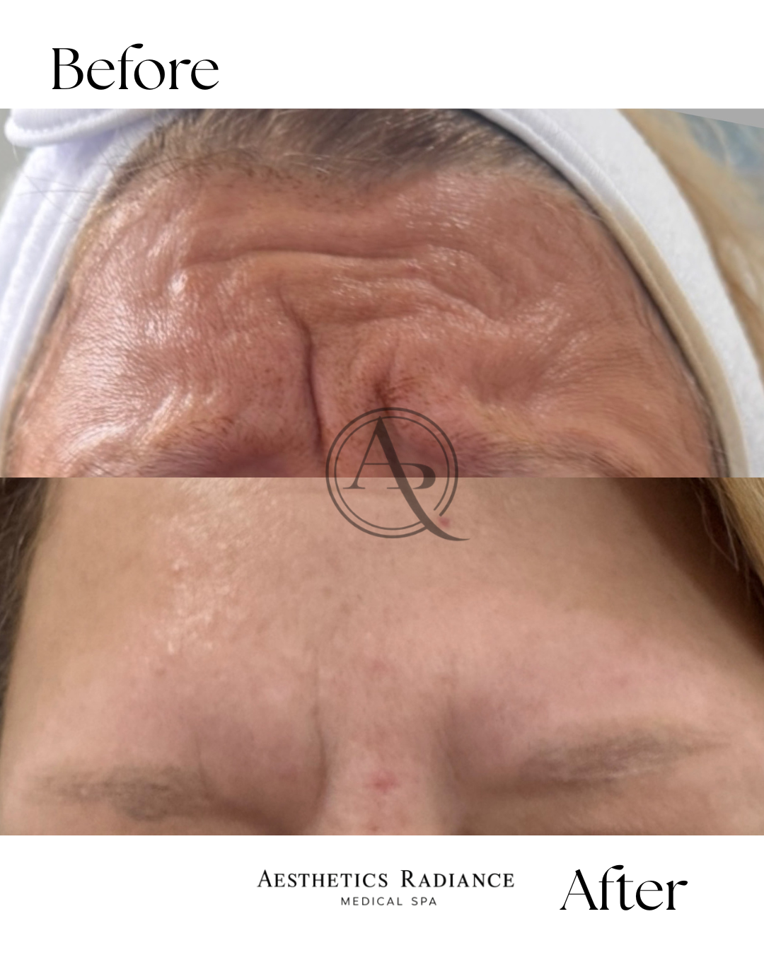 Comparison of forehead skin before and after aesthetic treatment, showing reduced wrinkles and smoother skin.