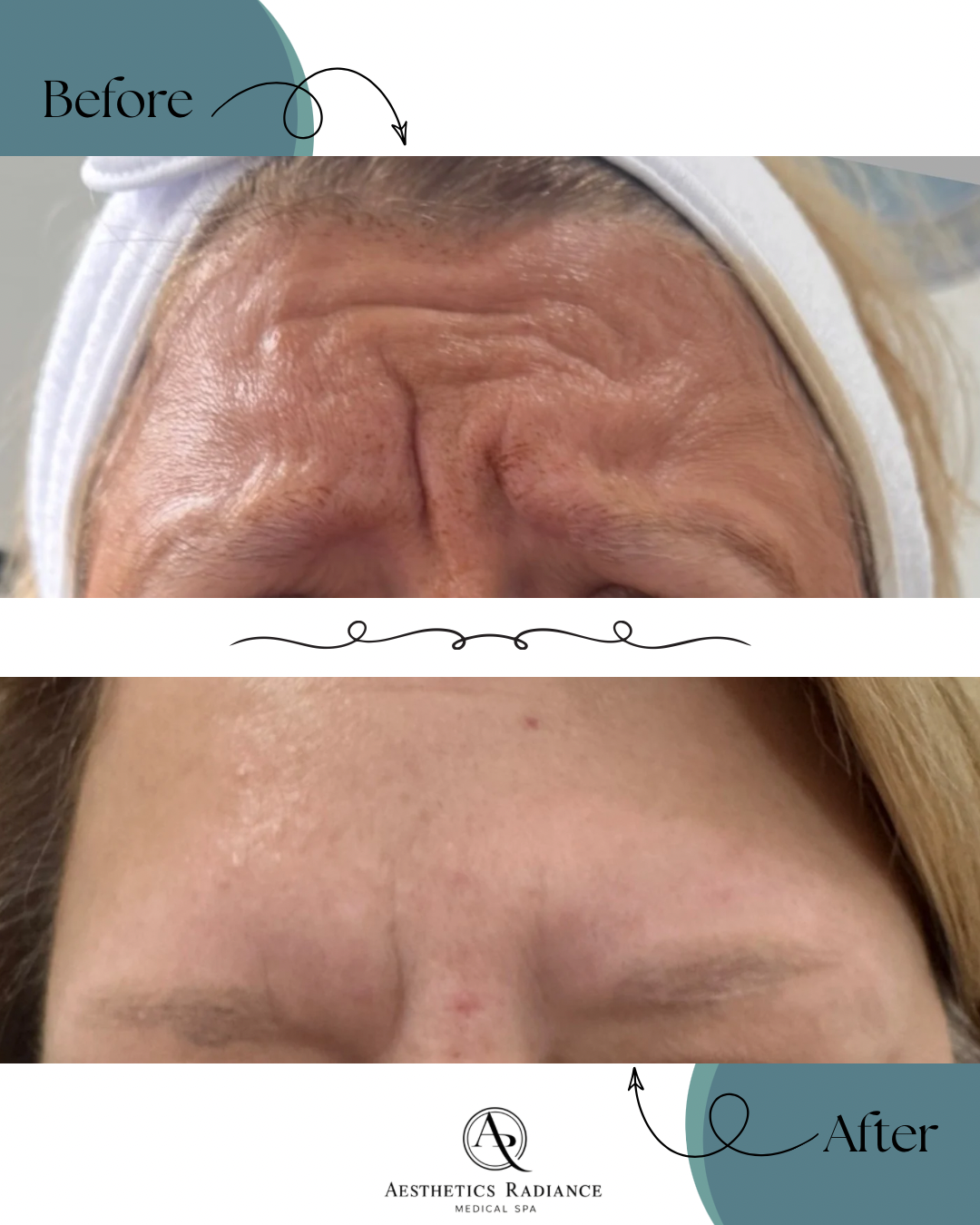 Before and After 1 peel treatment combined with glabellar complex and forehead DAXXIFY.
