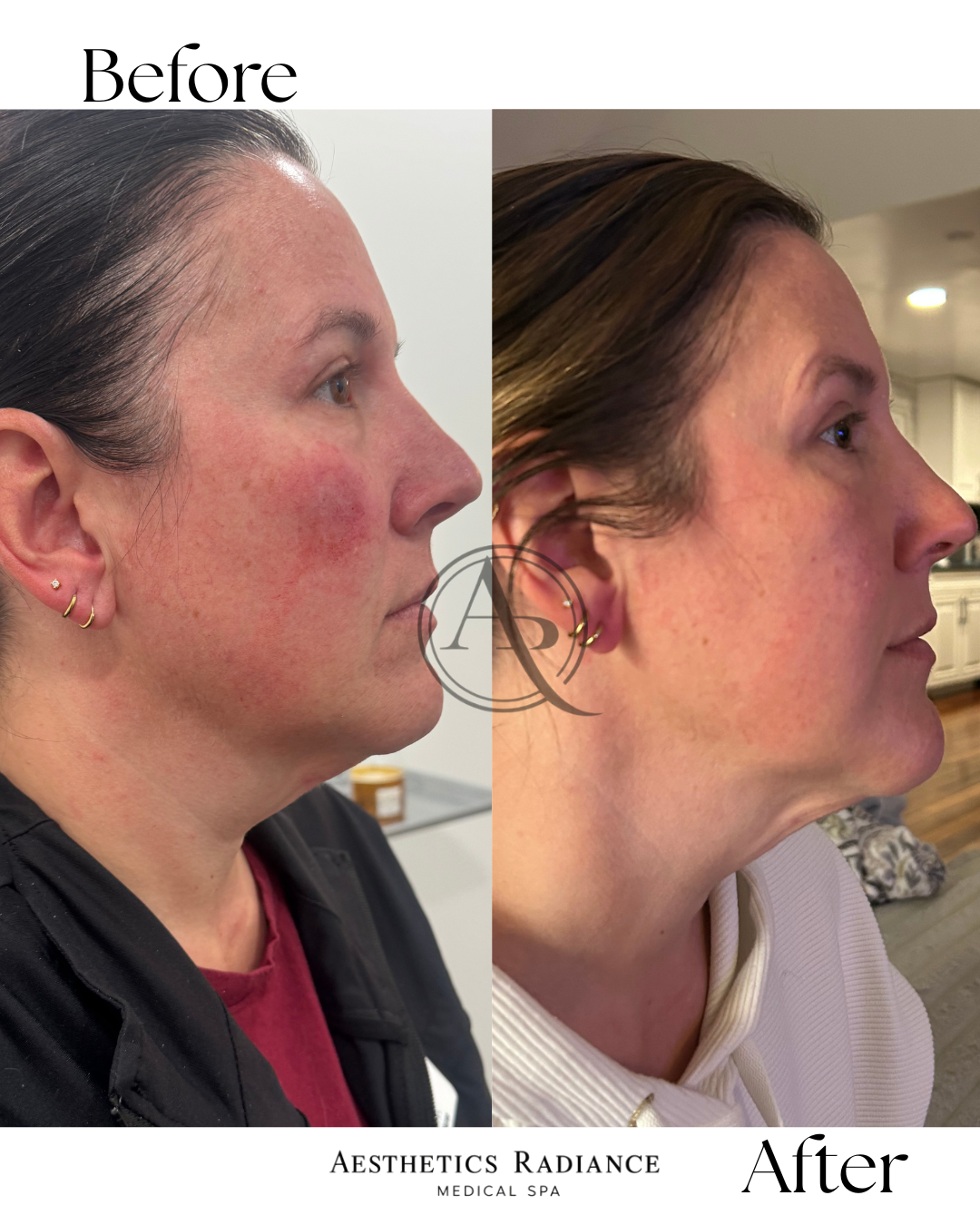 Side-by-side comparison of a woman's face before and after skincare treatment, showing clearer and smoother skin in the after image.