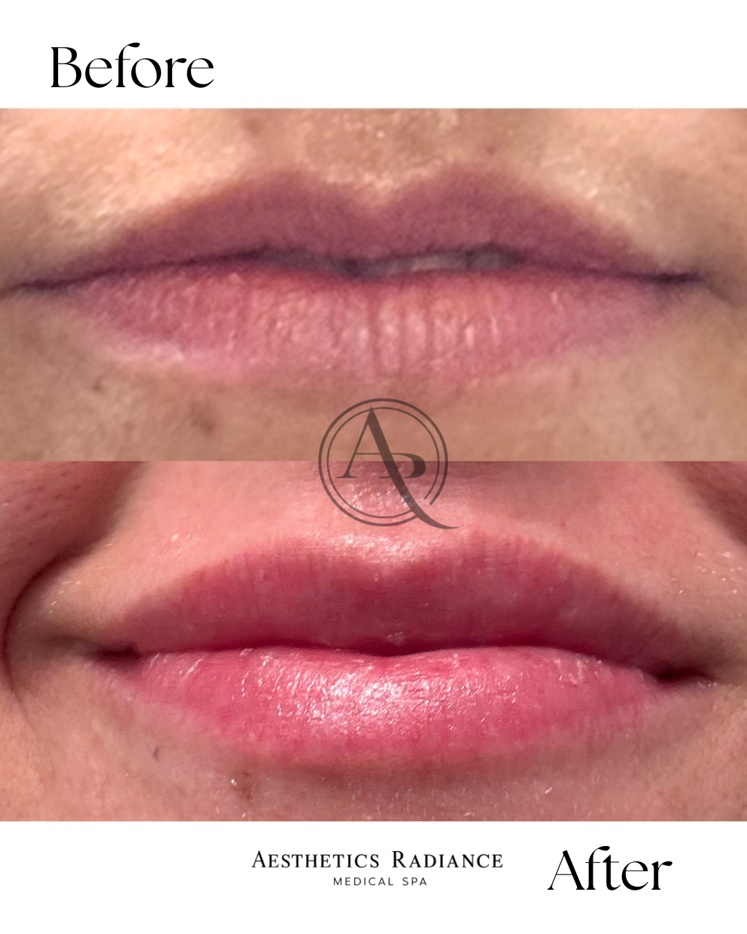 Before and After Mermaid Facial, BACIO for lips.