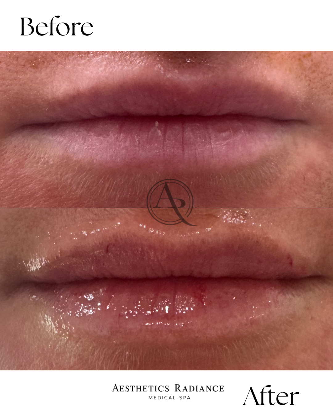 Lip Filler