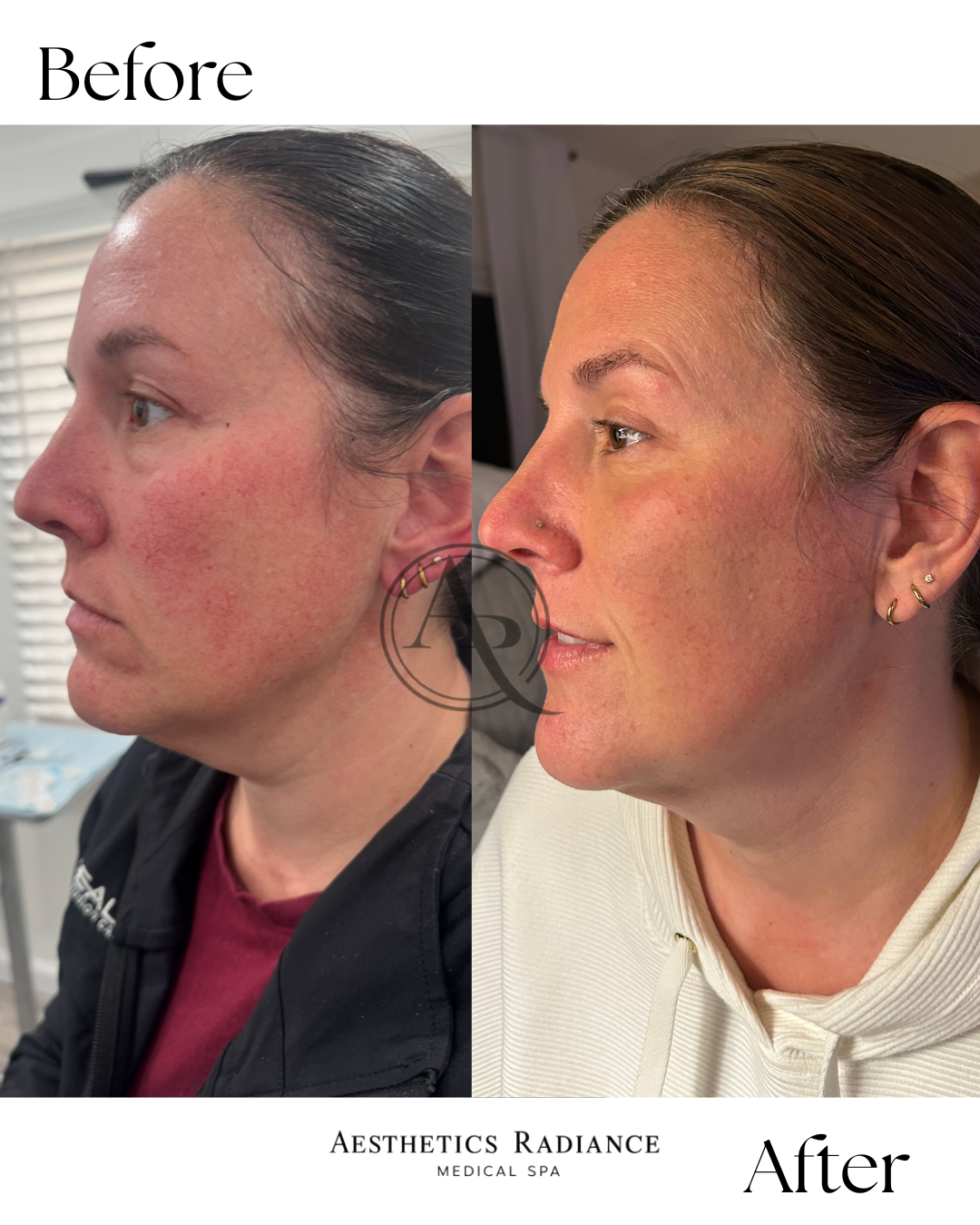 Side-by-side before and after photos of a woman showing clear skin, with the label 'Before' on the left and 'After' on the right, from Aesthetics Radiance Medical Spa.