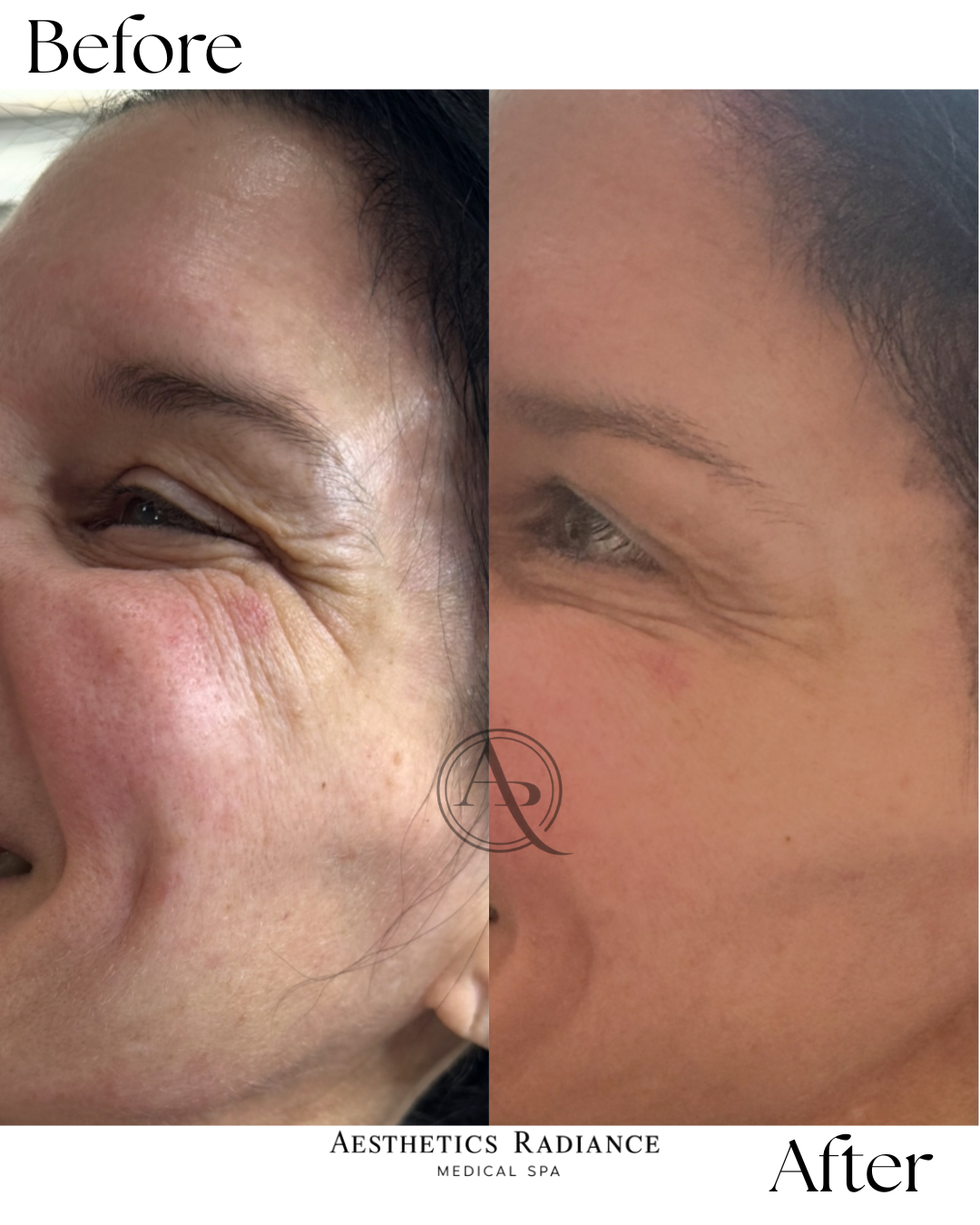 Crows Feet Injection