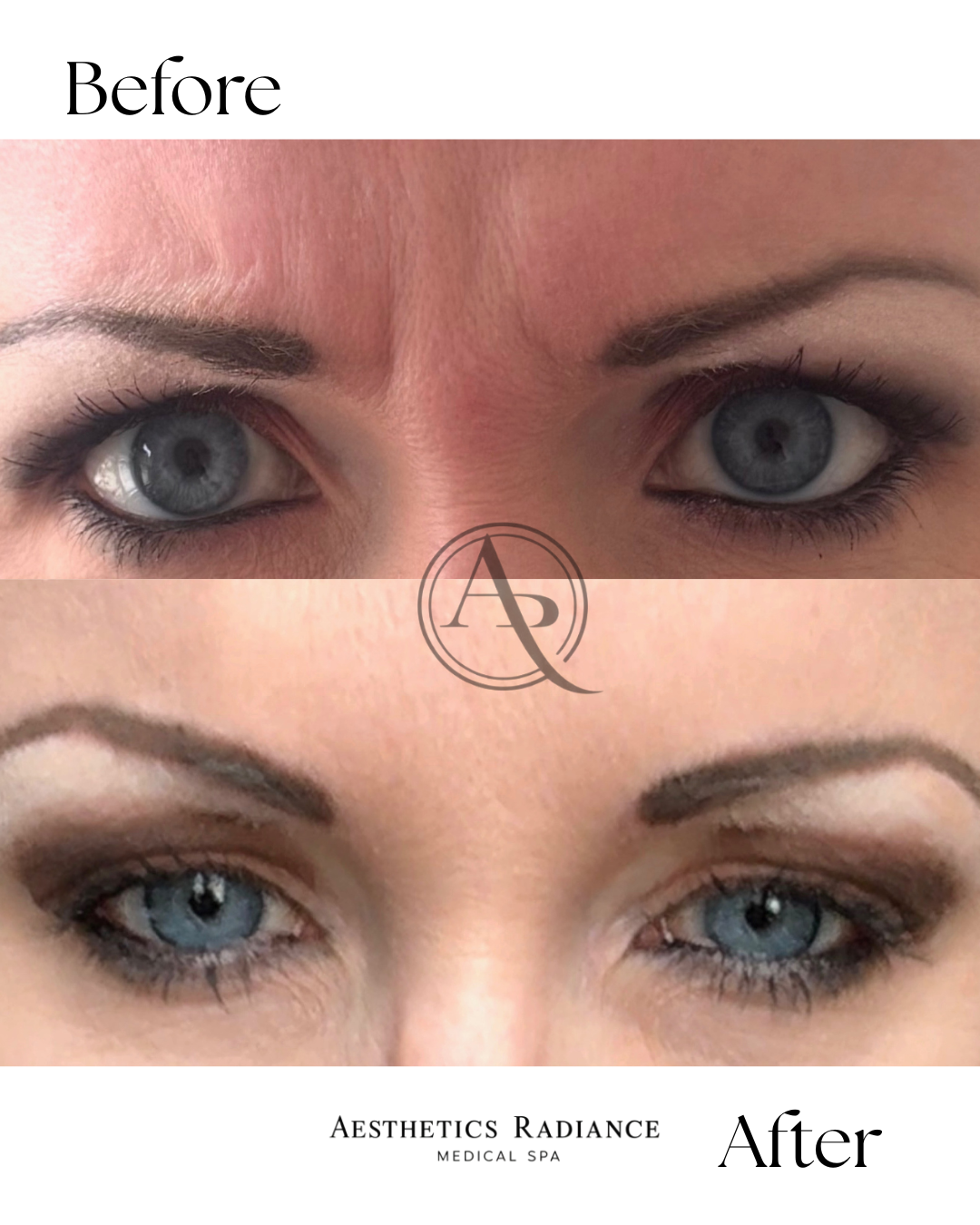 Before and after images of a woman's eyes showing cosmetic eyelid treatment, with the 'Before' image above and the 'After' image below, from Aesthetics Radiance Medical Spa.
