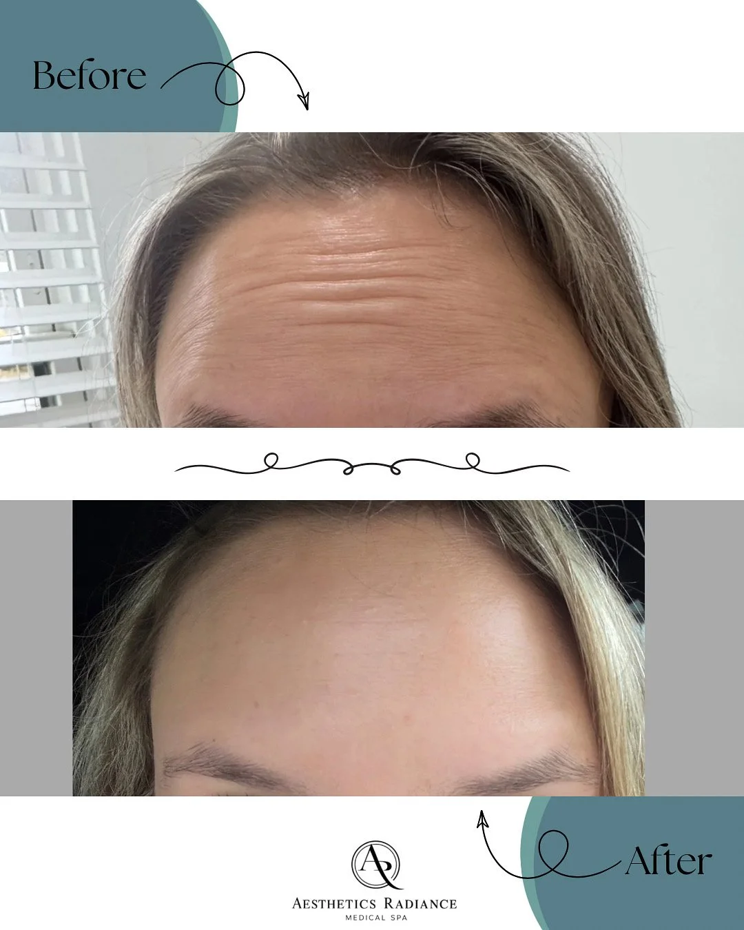 Before and After forehead lines treated with DAXXIFY. 