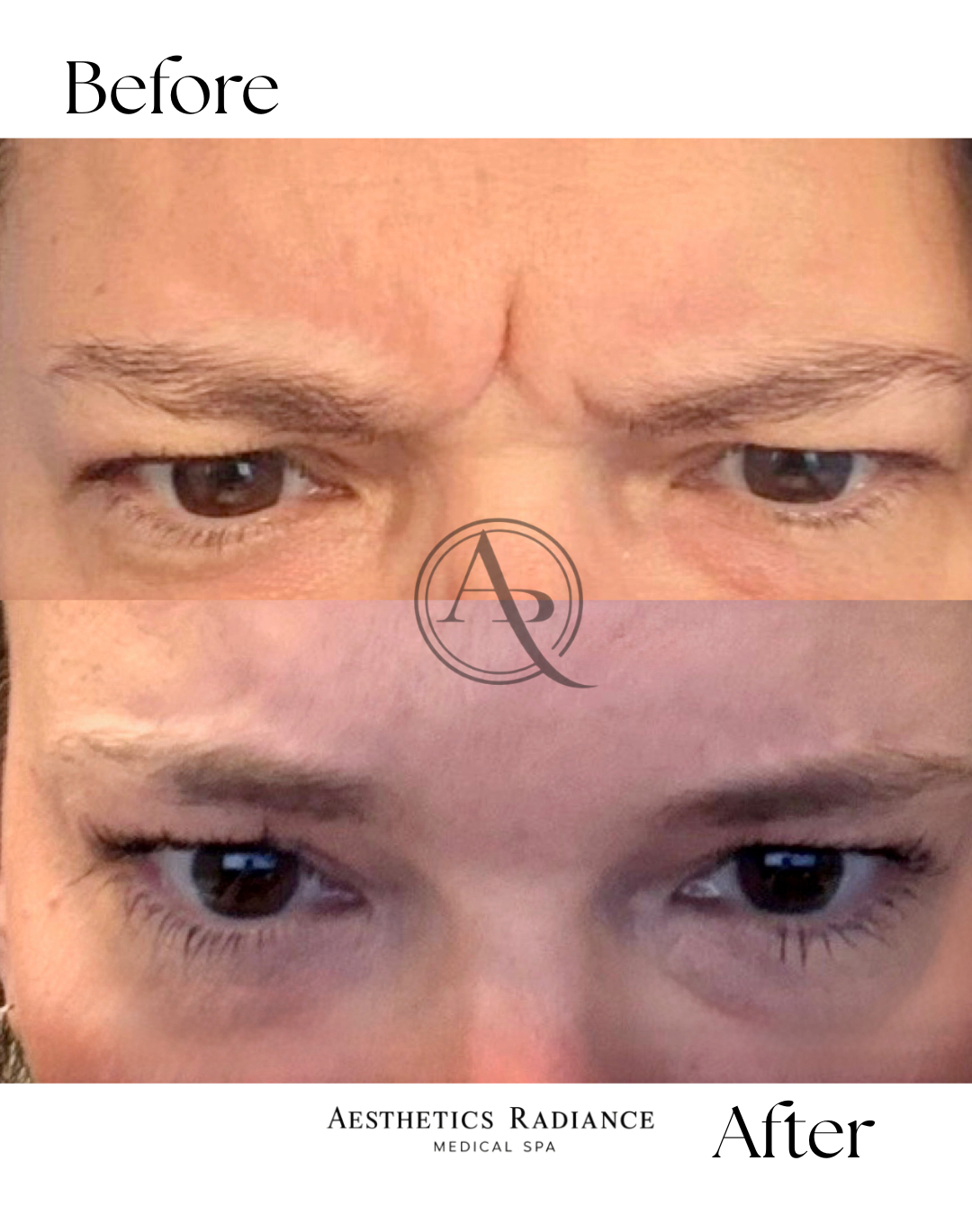 Close-up photo showing before and after results of aesthetic facial treatment, focusing on eyebrows and eye area.