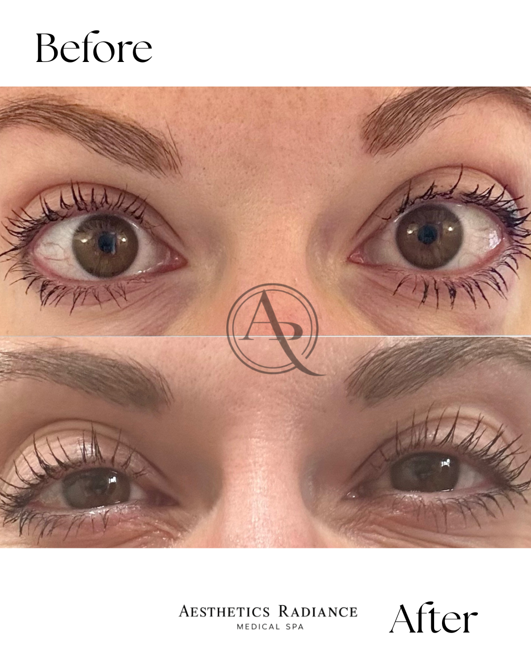 Close-up comparison of a woman's eyes before and after aesthetic treatment, showing changes in skin texture, brightness, and appearance of the eyes.