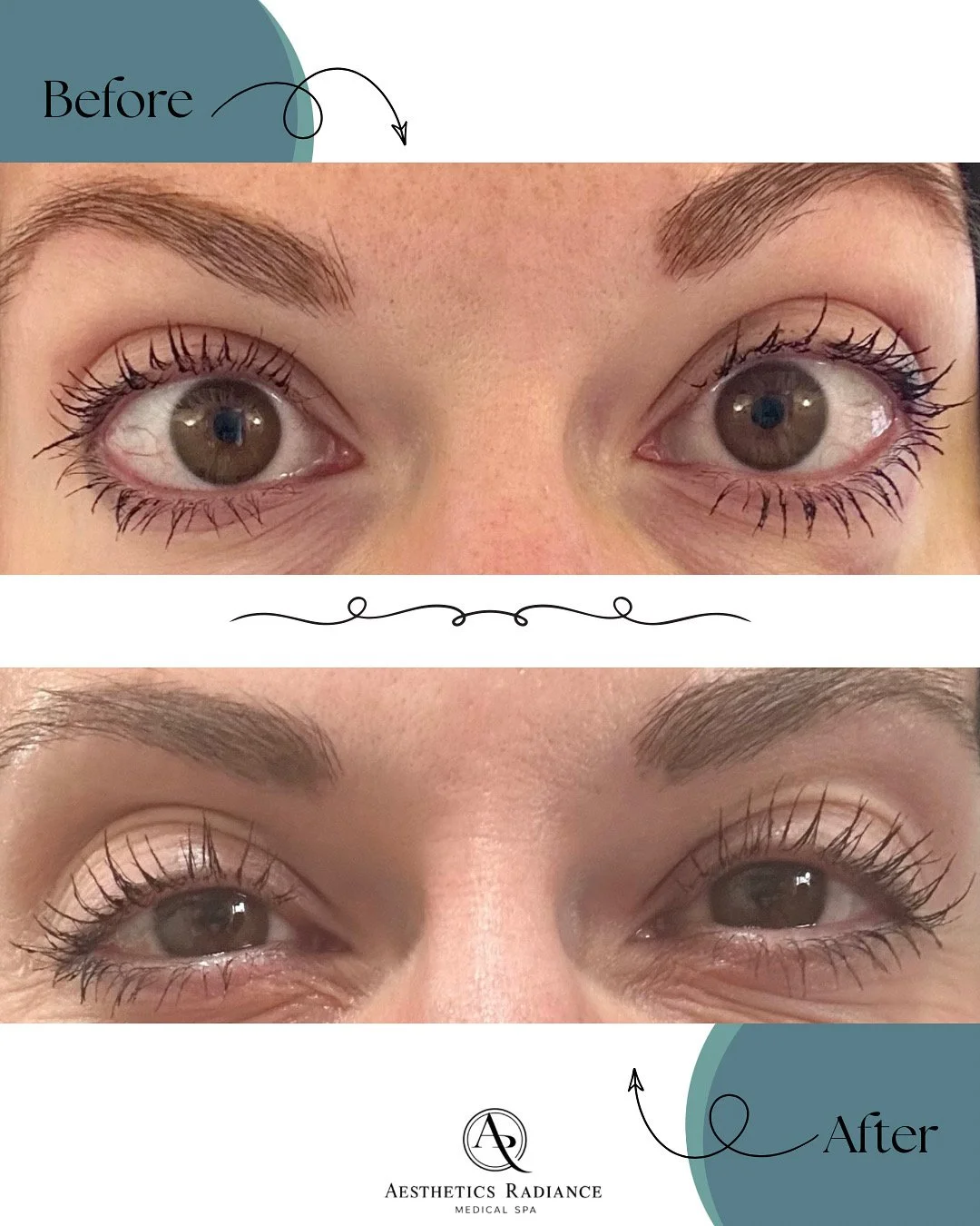 Before and After 3 months of Latisse Eyelash Growth Serum.