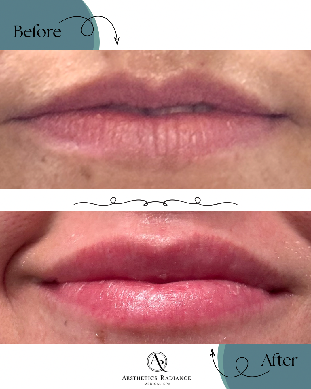 Before and After Mermaid Facial, BACIO for lips.