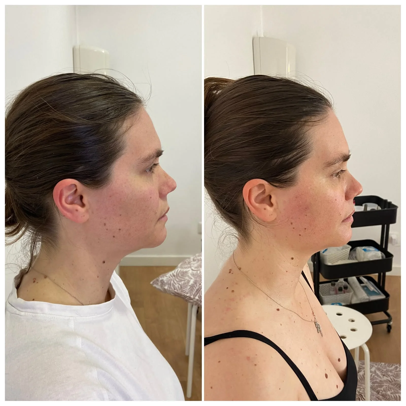 Antes & Depois da 1ª Sessão do Signature Therapy