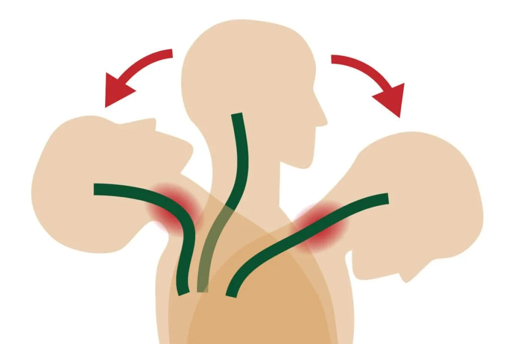 Whiplash injury diagram showing cervical spine trauma treated at Axis Chiropractic and Massage in West Valley City Utah