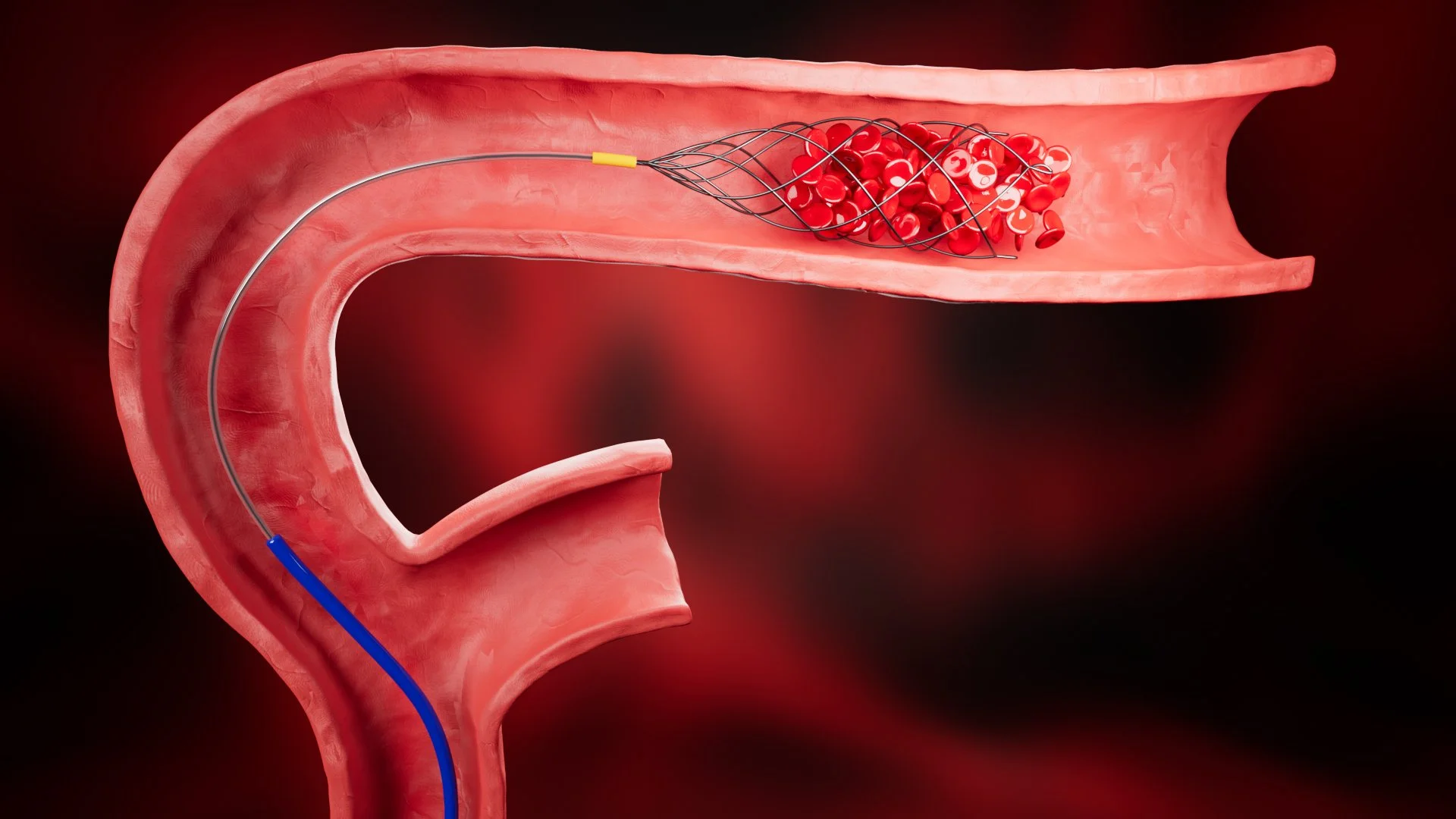 3D Modeling: Medical Procedure